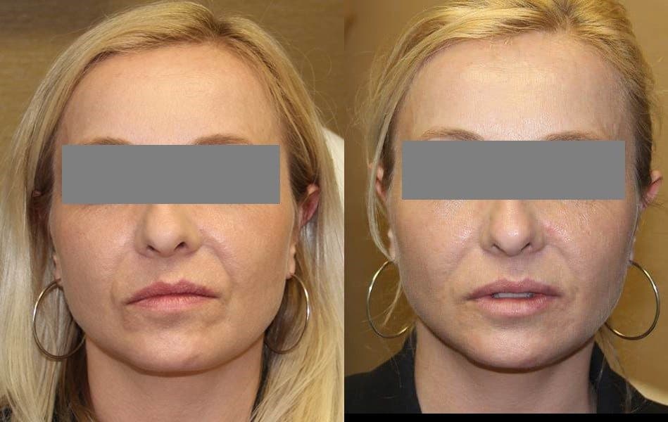 Restylane Silk