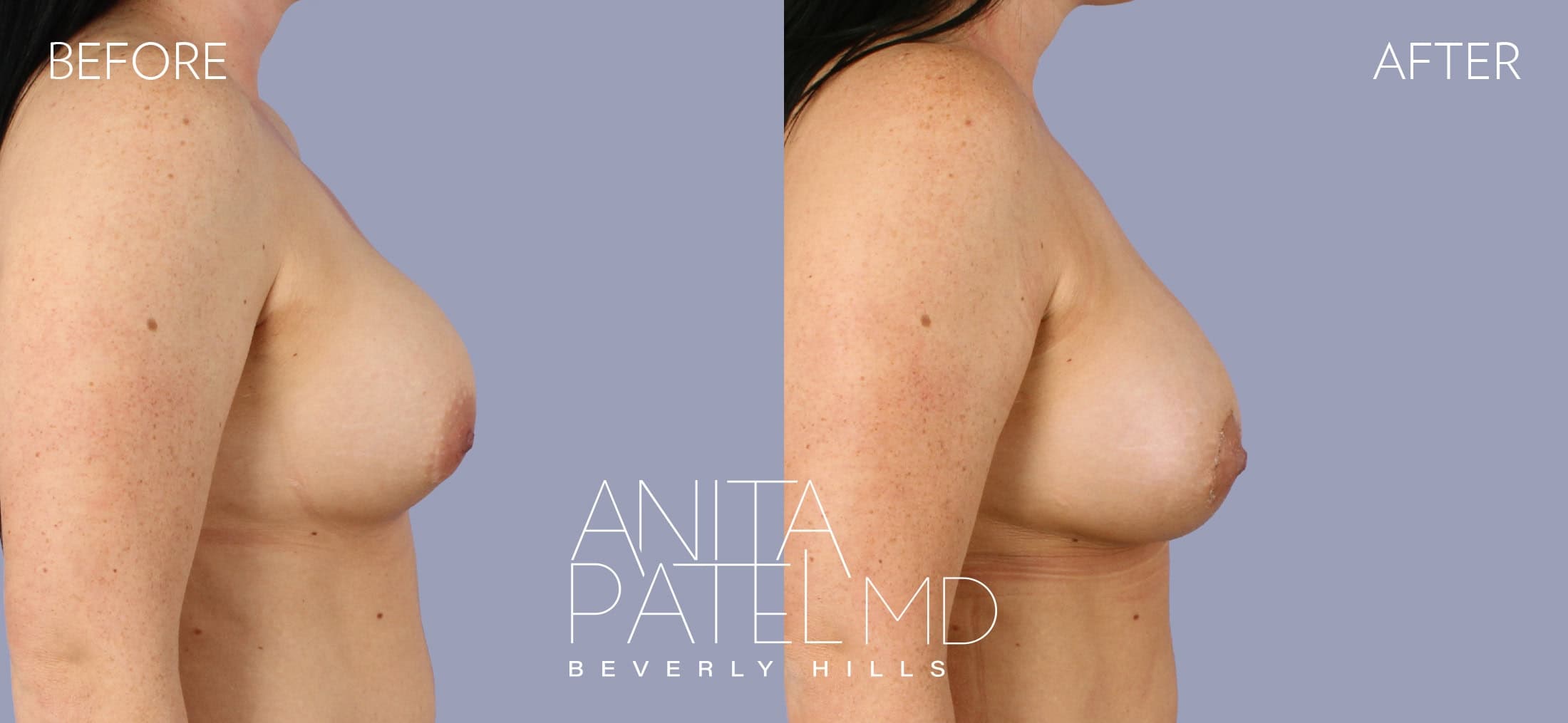 Breast Augmentation with Lift before and after — Patient 1, photo 1 of 5 — Dr. Anita Patel, MD, FACS, Beverly Hills