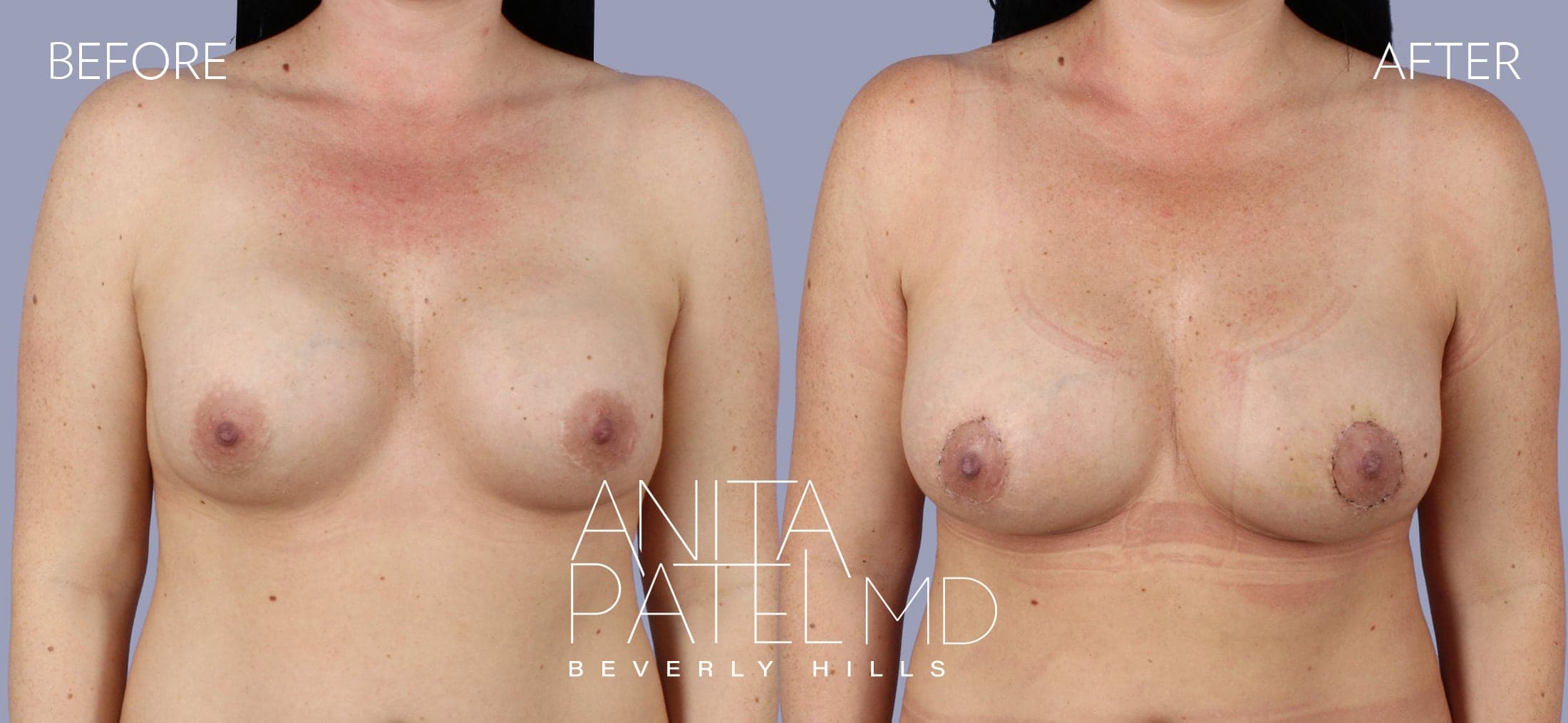 Breast Augmentation with Lift before and after — Patient 1, photo 2 of 5 — Dr. Anita Patel, MD, FACS, Beverly Hills