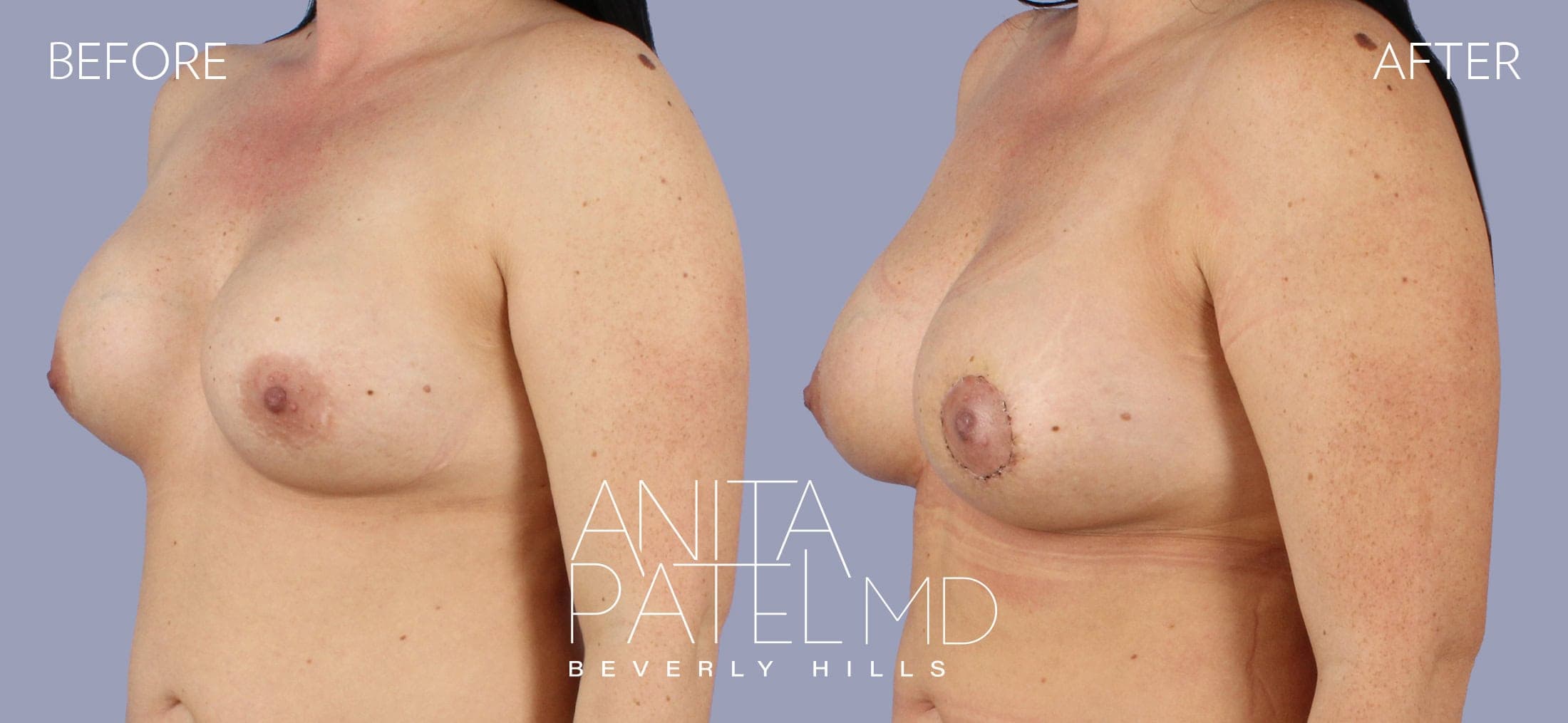 Breast Augmentation with Lift before and after — Patient 1, photo 4 of 5 — Dr. Anita Patel, MD, FACS, Beverly Hills