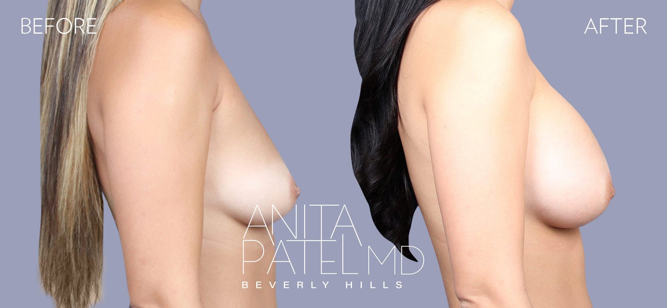 Breast Augmentation before and after — Patient 15, photo 2 of 4 — Dr. Anita Patel, MD, FACS, Beverly Hills