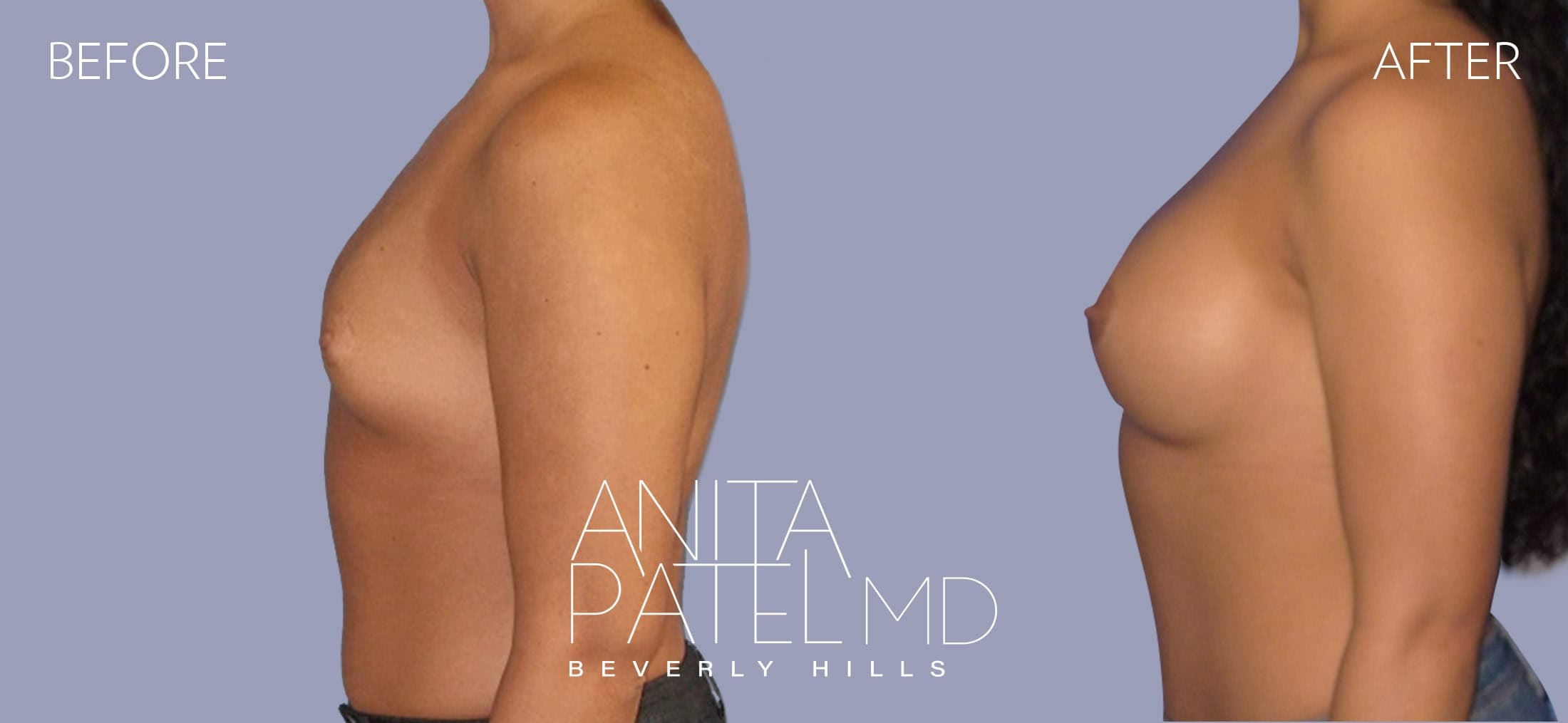 Breast Augmentation before and after — Patient 16, photo 1 of 3 — Dr. Anita Patel, MD, FACS, Beverly Hills