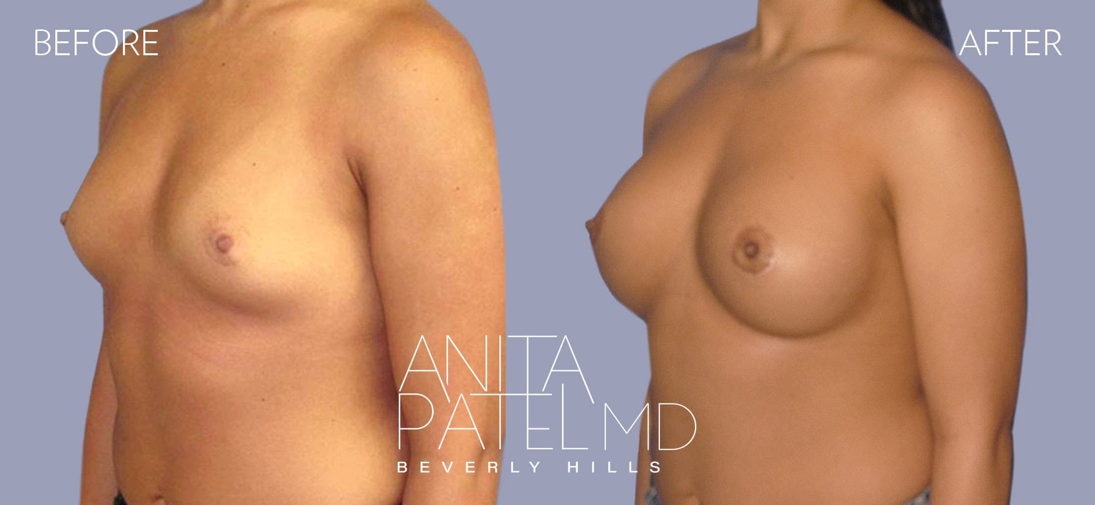 Breast Augmentation before and after — Patient 16, photo 2 of 3 — Dr. Anita Patel, MD, FACS, Beverly Hills