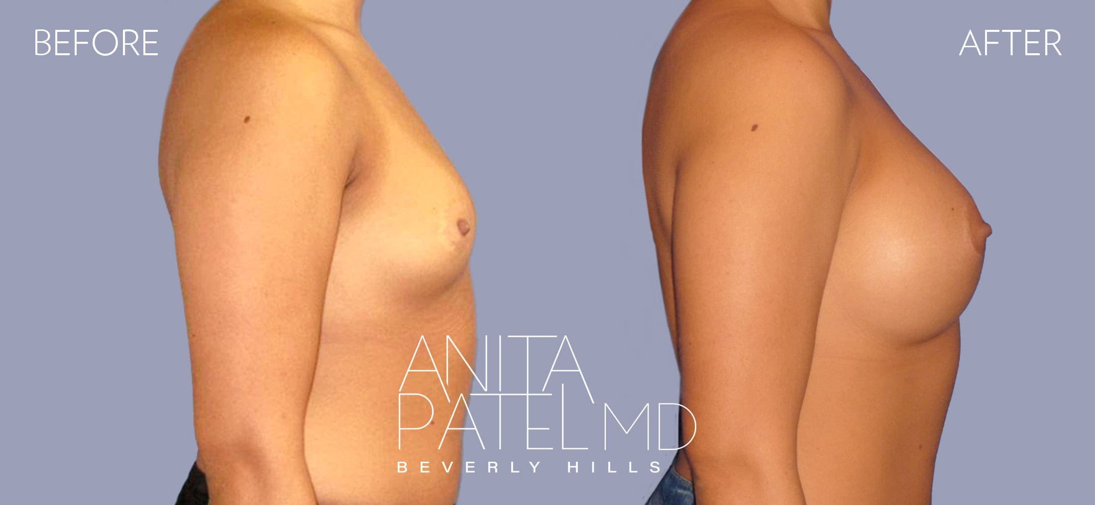 Breast Augmentation before and after — Patient 16, photo 3 of 3 — Dr. Anita Patel, MD, FACS, Beverly Hills