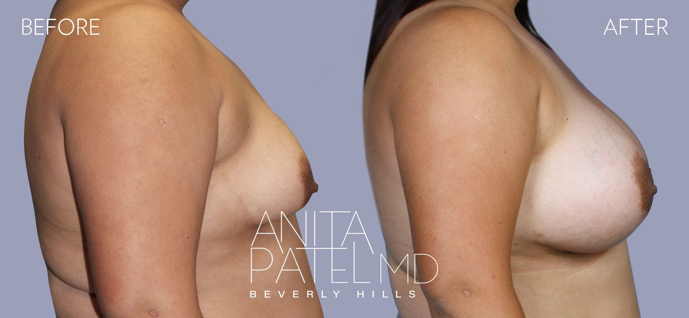 Breast Augmentation before and after — Patient 17 — Dr. Anita Patel, MD, FACS, Beverly Hills