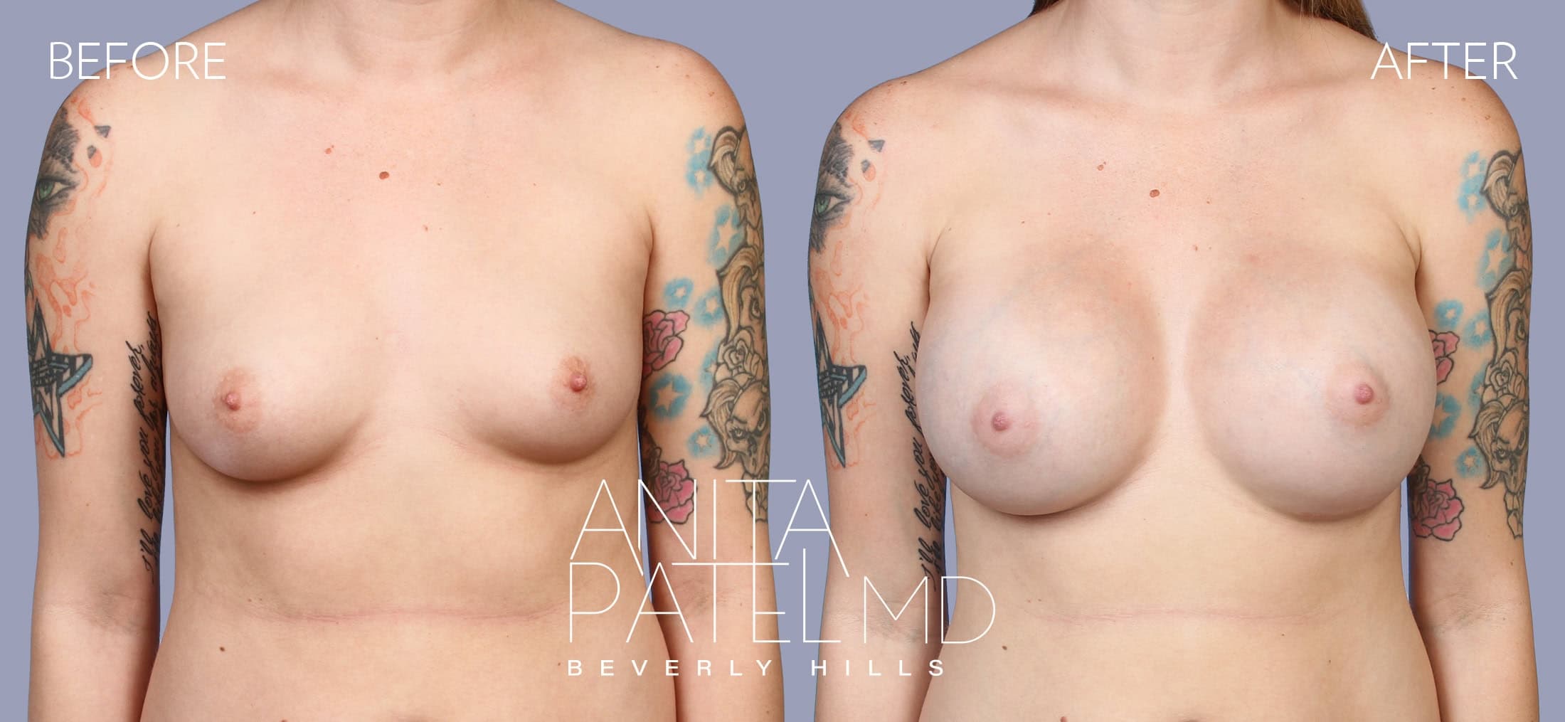 Breast Augmentation before and after — Patient 19, photo 1 of 5 — Dr. Anita Patel, MD, FACS, Beverly Hills