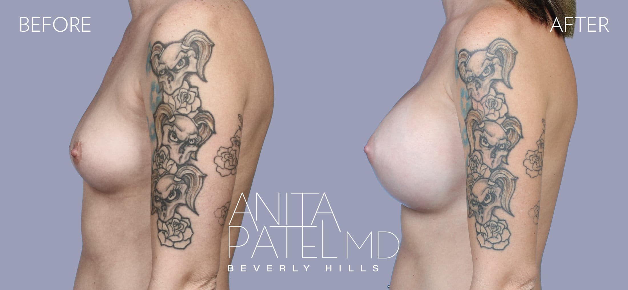 Breast Augmentation before and after — Patient 19, photo 3 of 5 — Dr. Anita Patel, MD, FACS, Beverly Hills