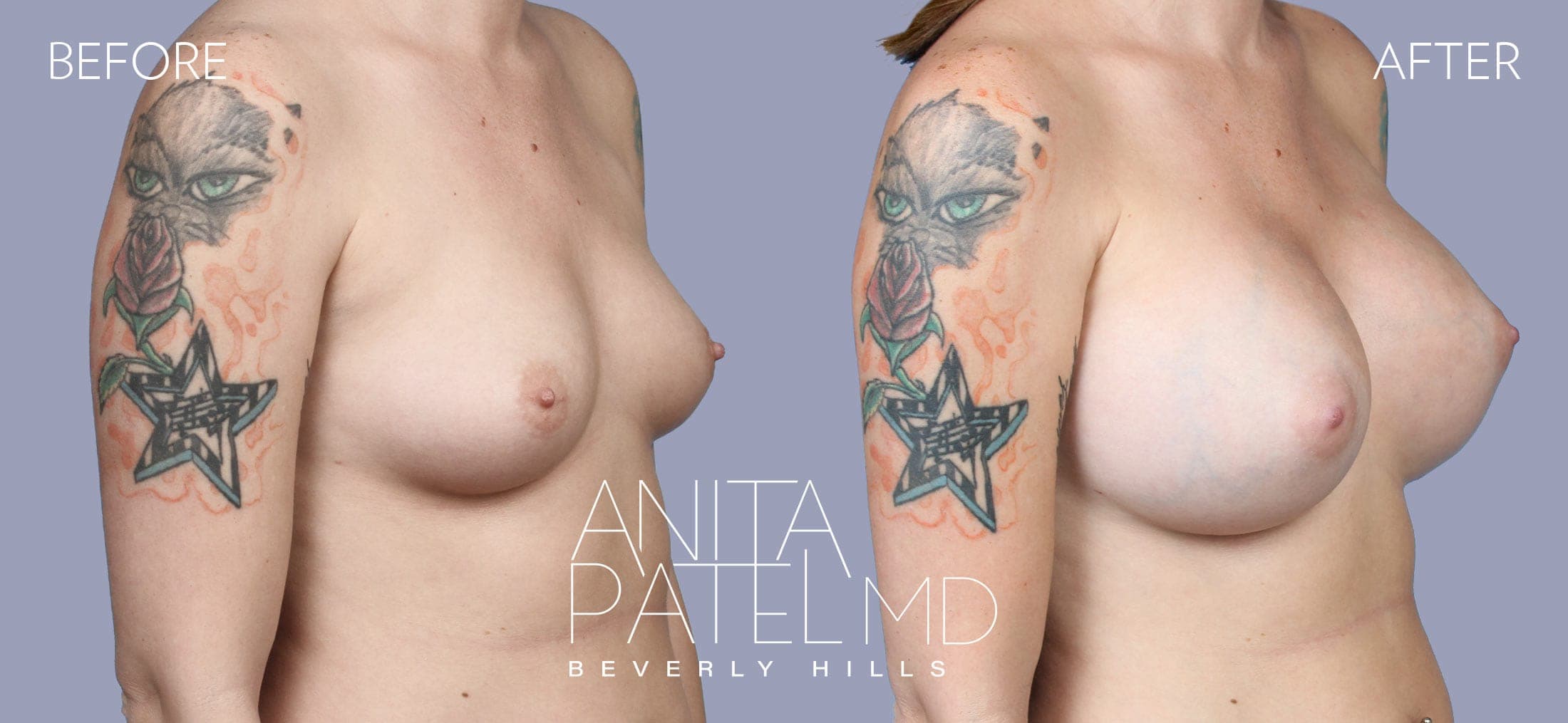 Breast Augmentation before and after — Patient 19, photo 4 of 5 — Dr. Anita Patel, MD, FACS, Beverly Hills