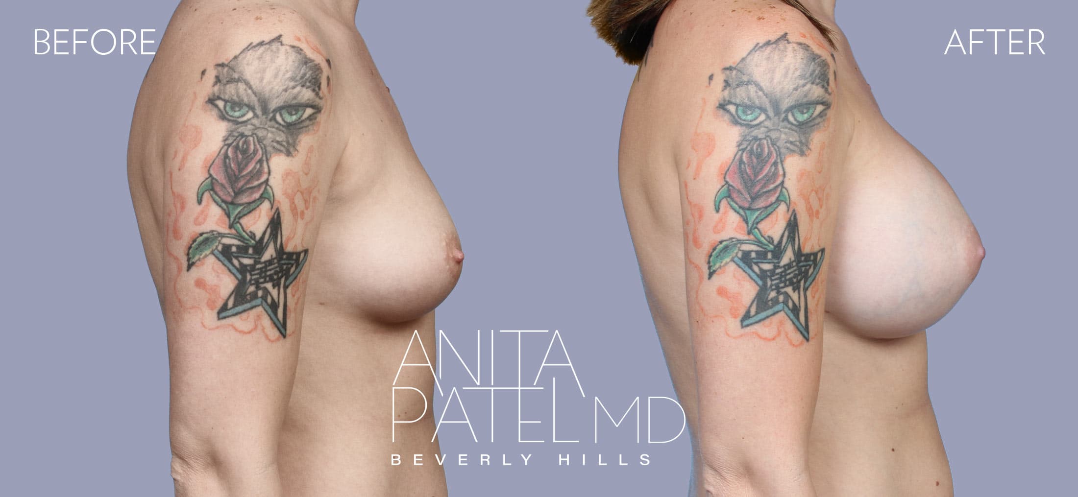 Breast Augmentation before and after — Patient 19, photo 5 of 5 — Dr. Anita Patel, MD, FACS, Beverly Hills