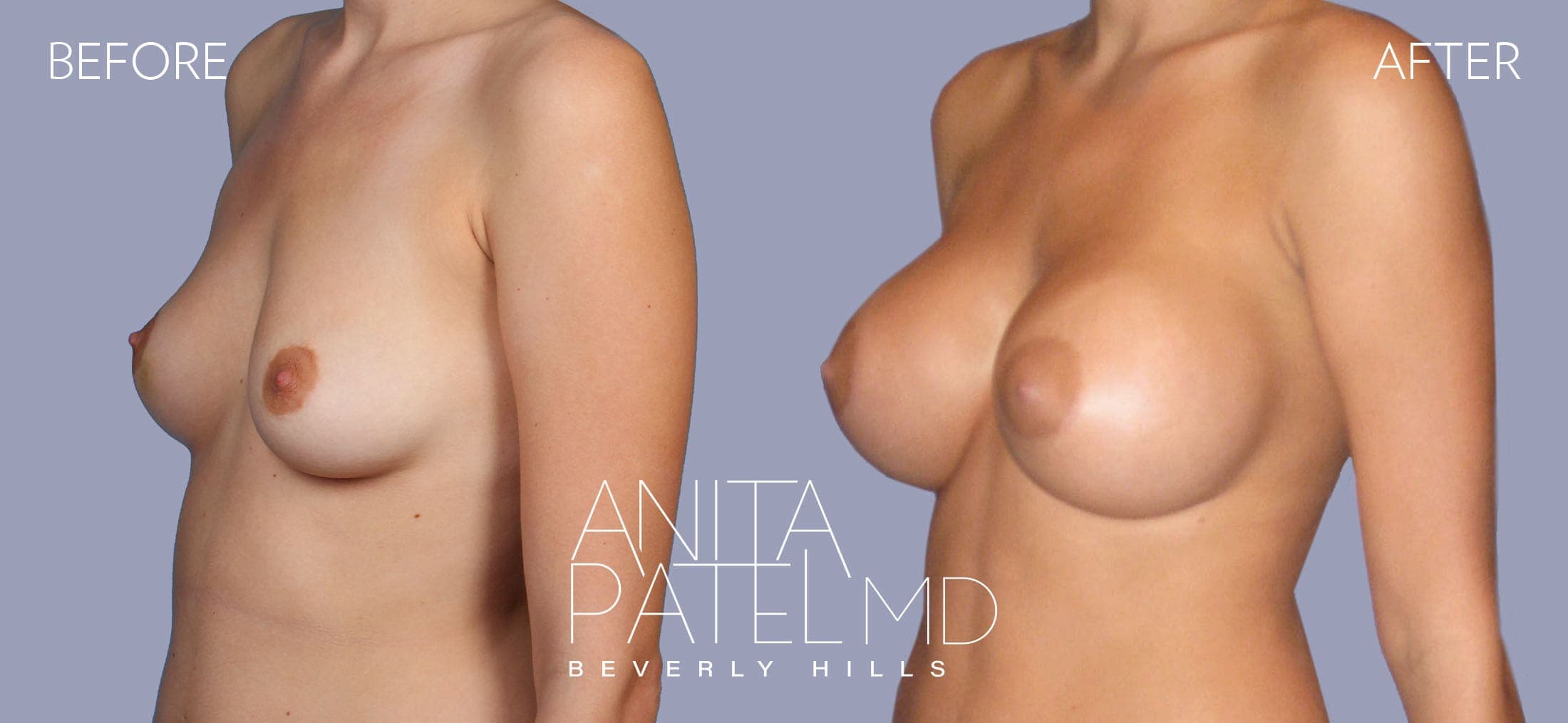 Breast Augmentation before and after — Patient 20, photo 4 of 5 — Dr. Anita Patel, MD, FACS, Beverly Hills