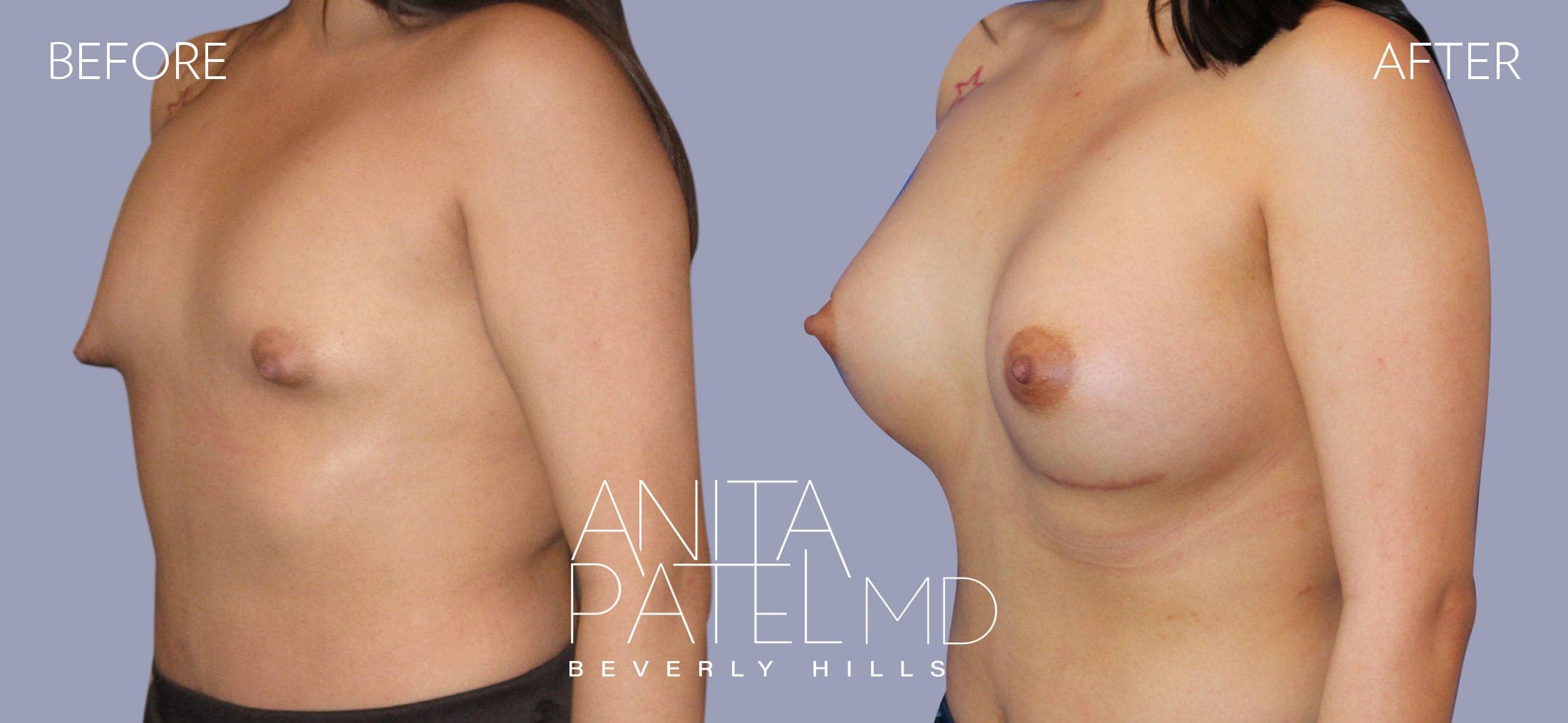 Breast Augmentation before and after — Patient 21, photo 1 of 5 — Dr. Anita Patel, MD, FACS, Beverly Hills