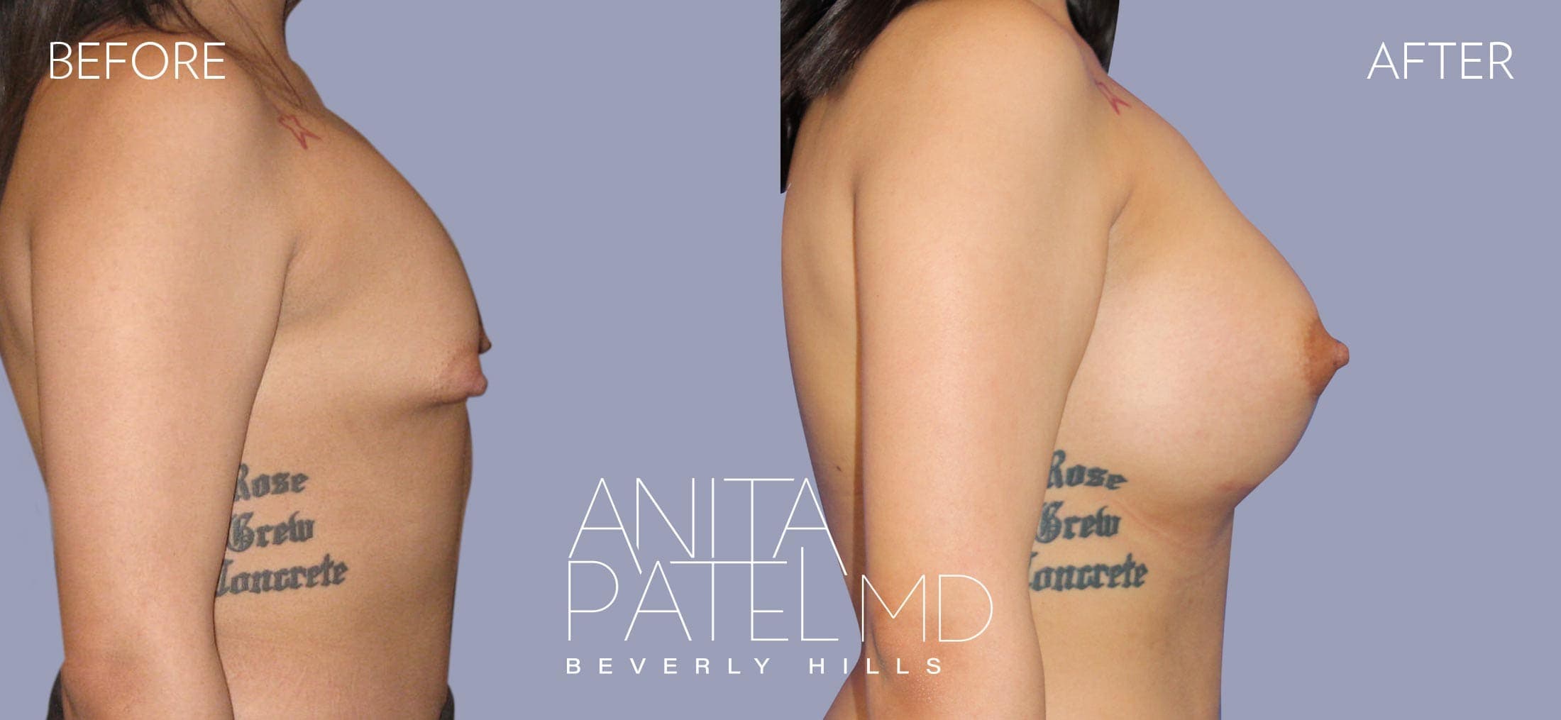 Breast Augmentation before and after — Patient 21, photo 2 of 5 — Dr. Anita Patel, MD, FACS, Beverly Hills
