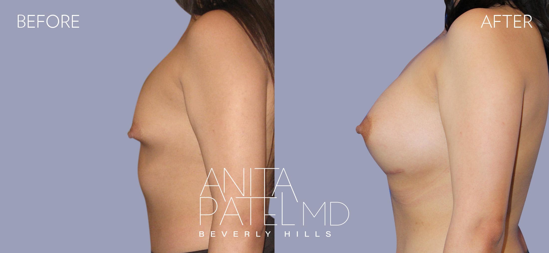 Breast Augmentation before and after — Patient 21, photo 4 of 5 — Dr. Anita Patel, MD, FACS, Beverly Hills