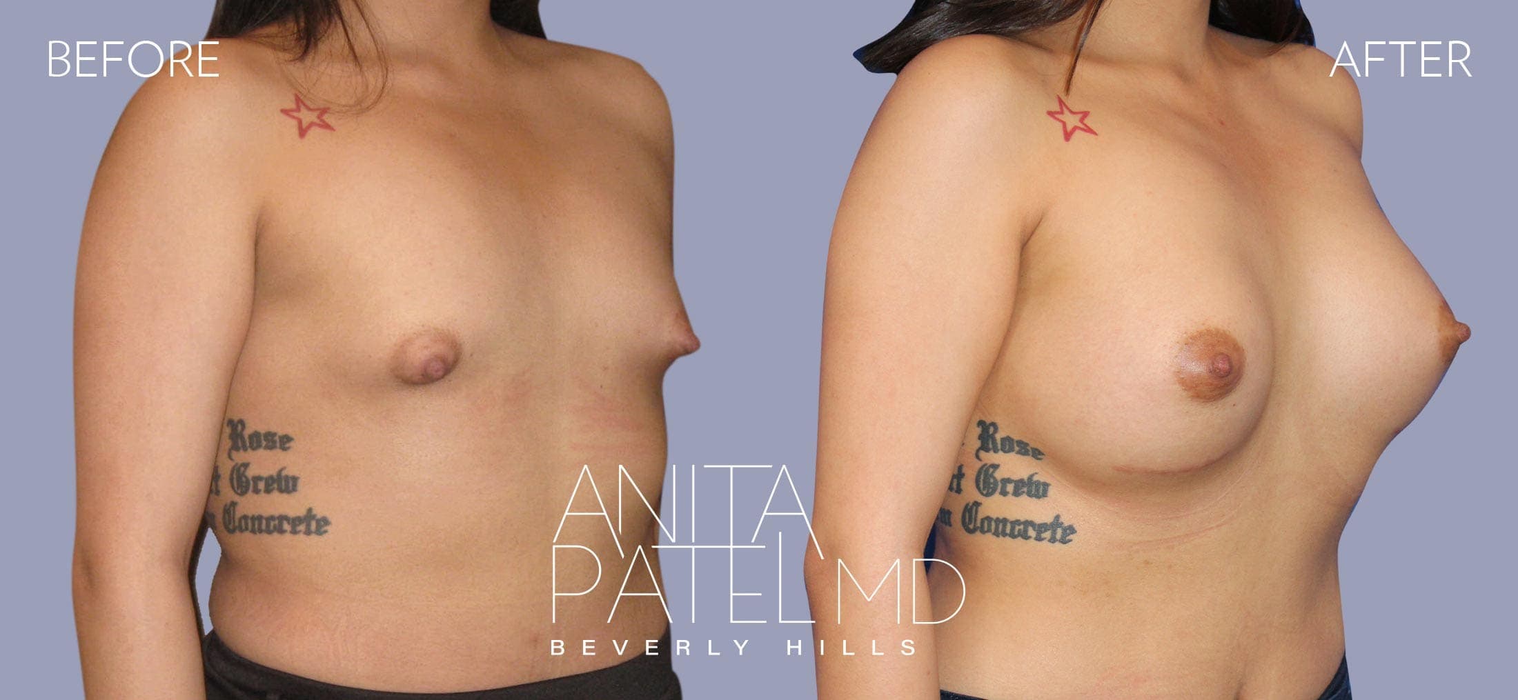 Breast Augmentation before and after — Patient 21, photo 5 of 5 — Dr. Anita Patel, MD, FACS, Beverly Hills