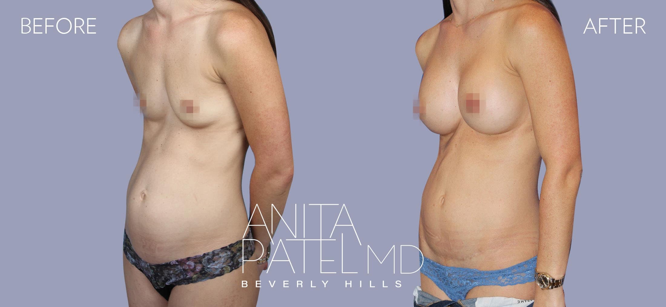 Tummy Tuck before and after — Patient 17, photo 4 of 5 — Dr. Anita Patel, MD, FACS, Beverly Hills
