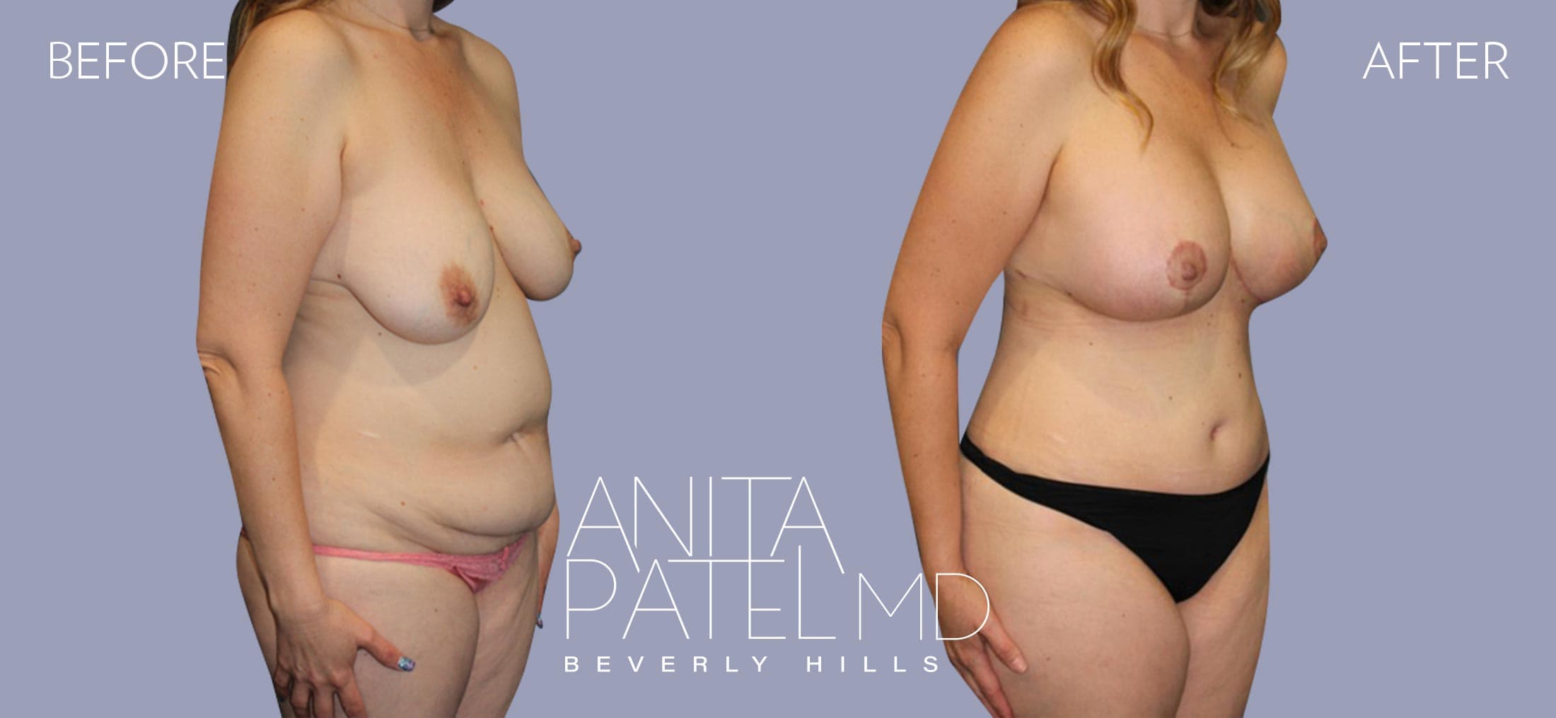 Tummy Tuck before and after — Patient 12, photo 1 of 4 — Dr. Anita Patel, MD, FACS, Beverly Hills
