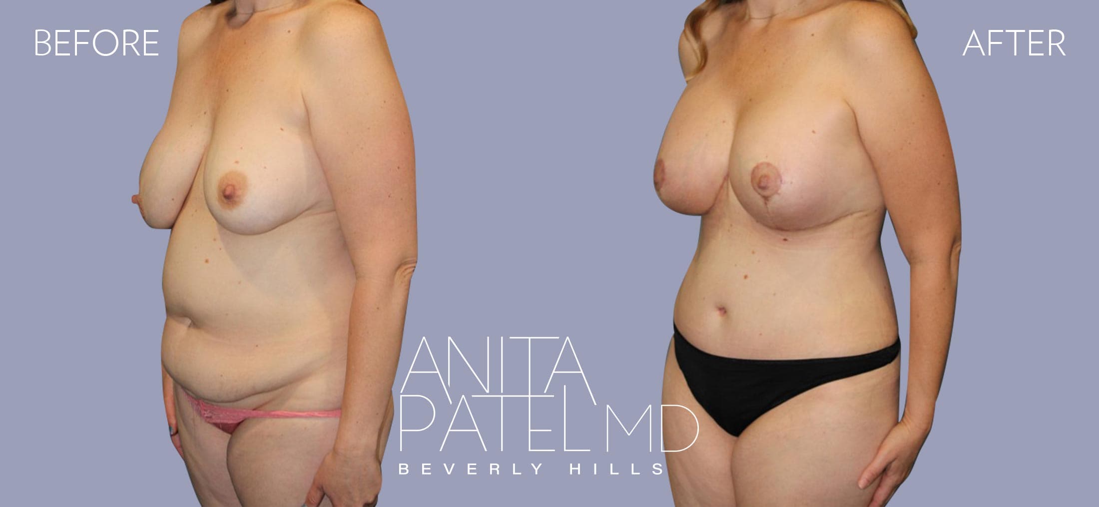 Tummy Tuck before and after — Patient 12, photo 2 of 4 — Dr. Anita Patel, MD, FACS, Beverly Hills