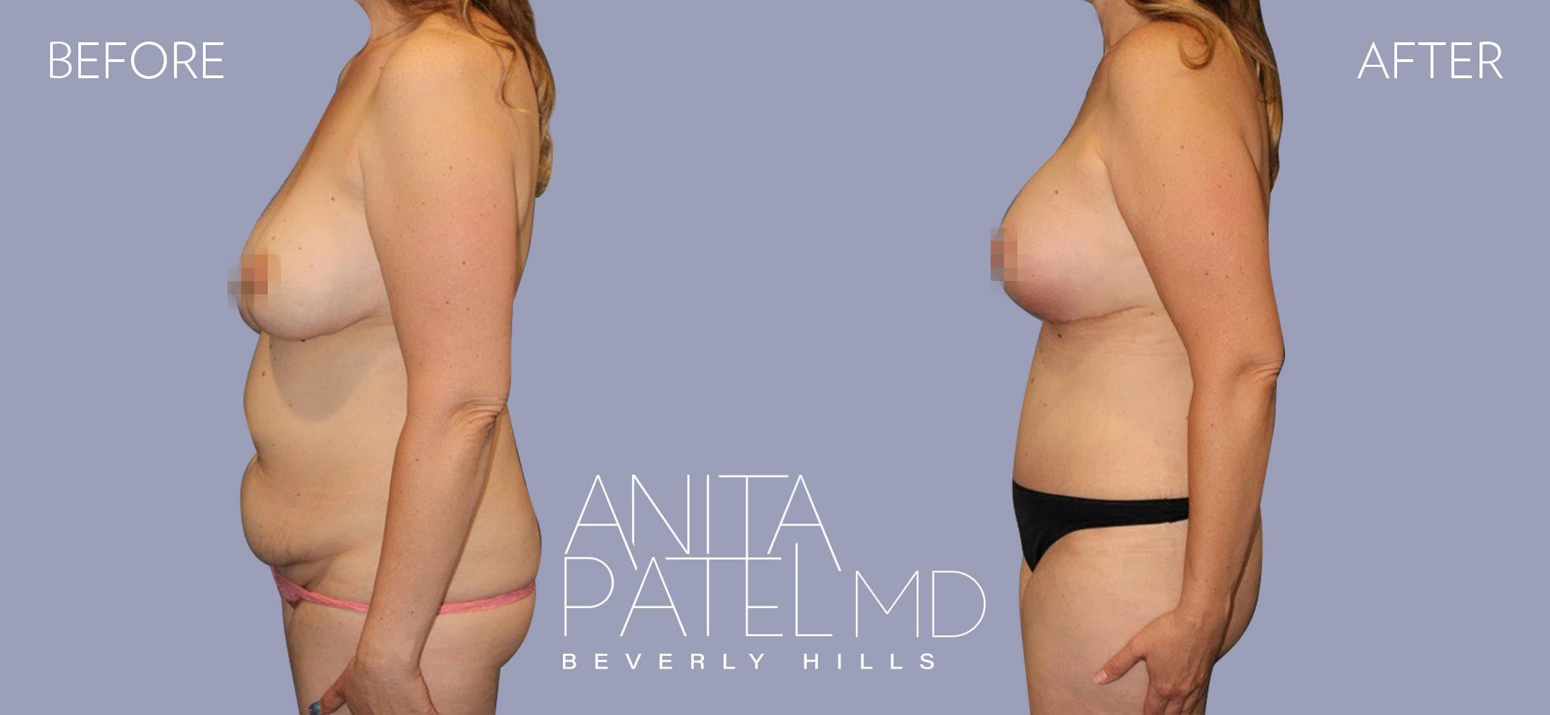 Tummy Tuck before and after — Patient 12, photo 3 of 4 — Dr. Anita Patel, MD, FACS, Beverly Hills