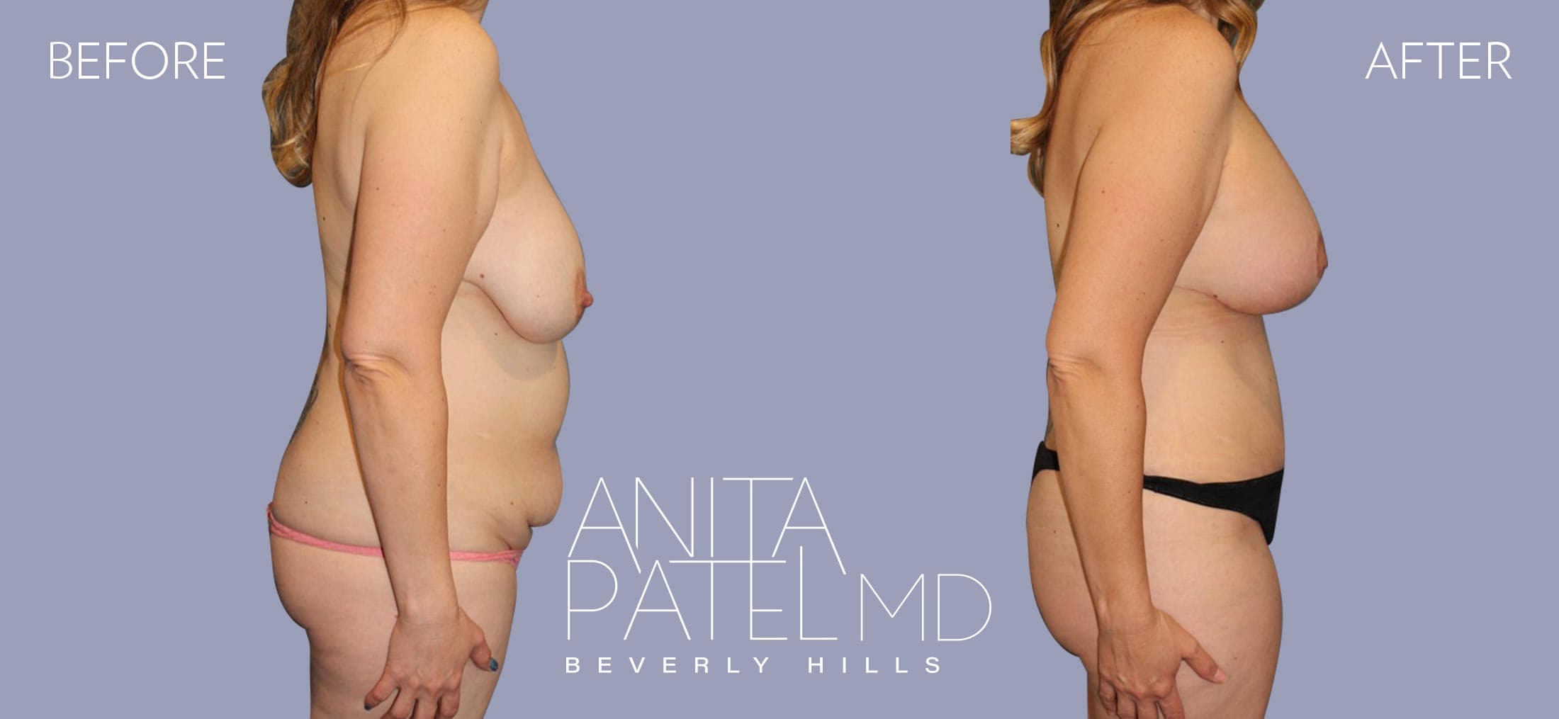 Mommy Makeover before and after — Patient 1, photo 4 of 4 — Dr. Anita Patel, MD, FACS, Beverly Hills