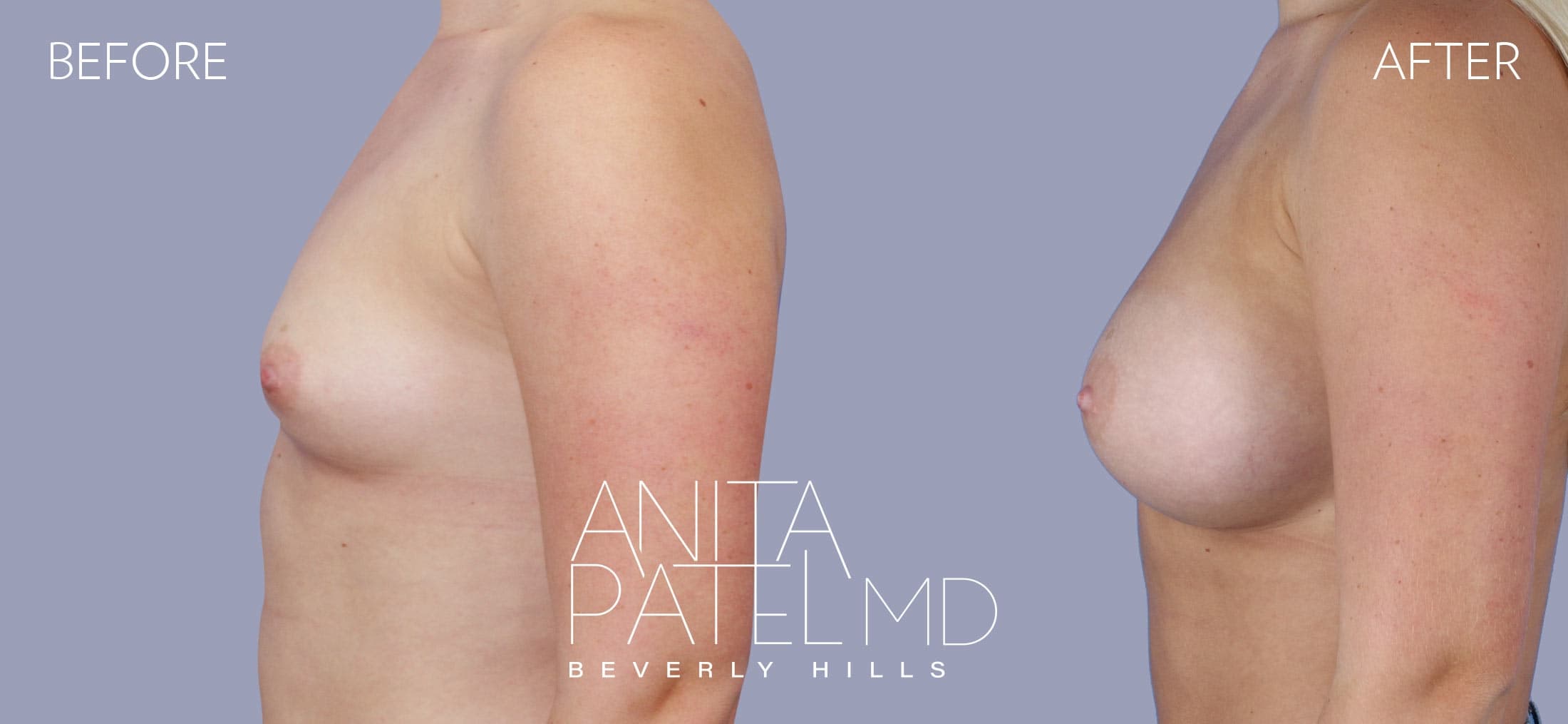Breast Augmentation before and after — Patient 24 — Dr. Anita Patel, MD, FACS, Beverly Hills