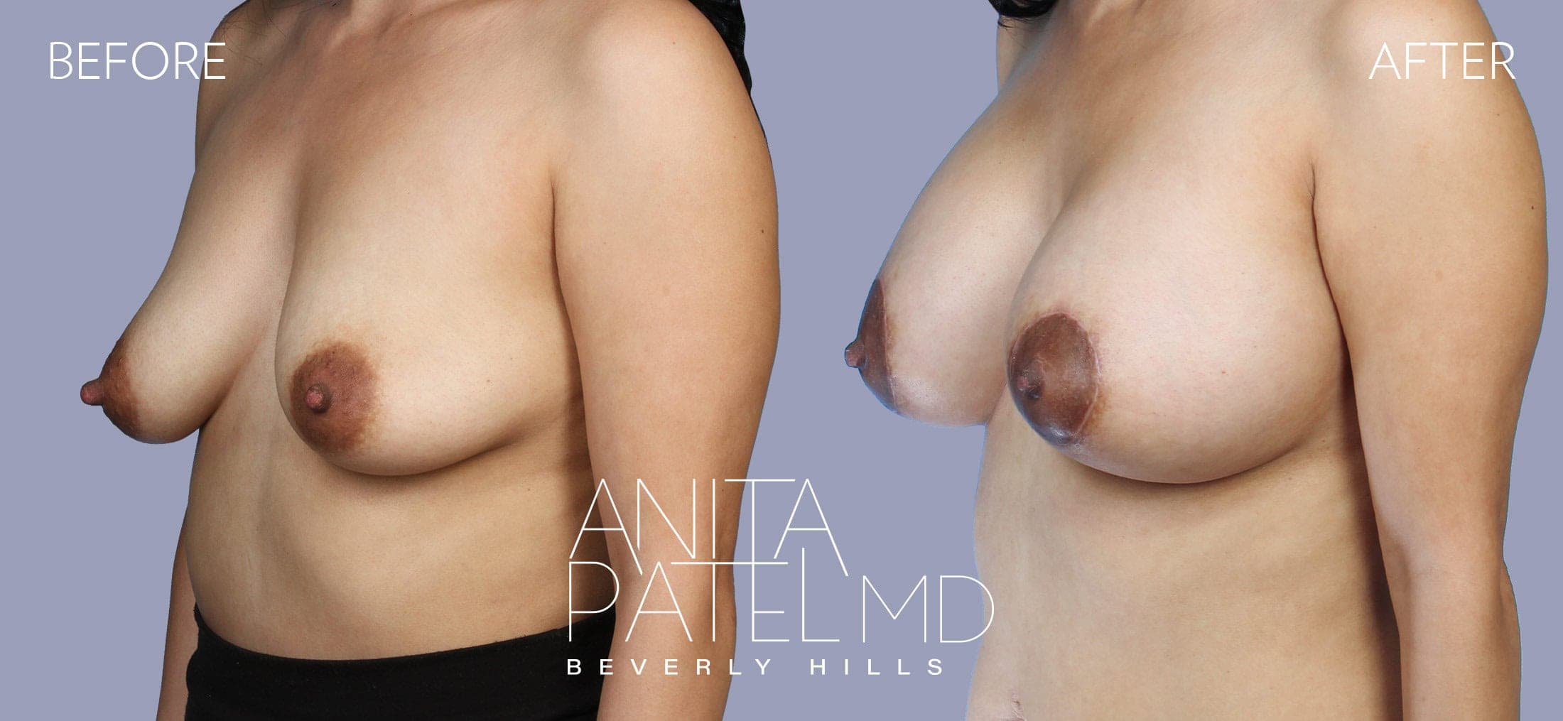 Breast Augmentation with Lift before and after — Patient 3, photo 4 of 5 — Dr. Anita Patel, MD, FACS, Beverly Hills