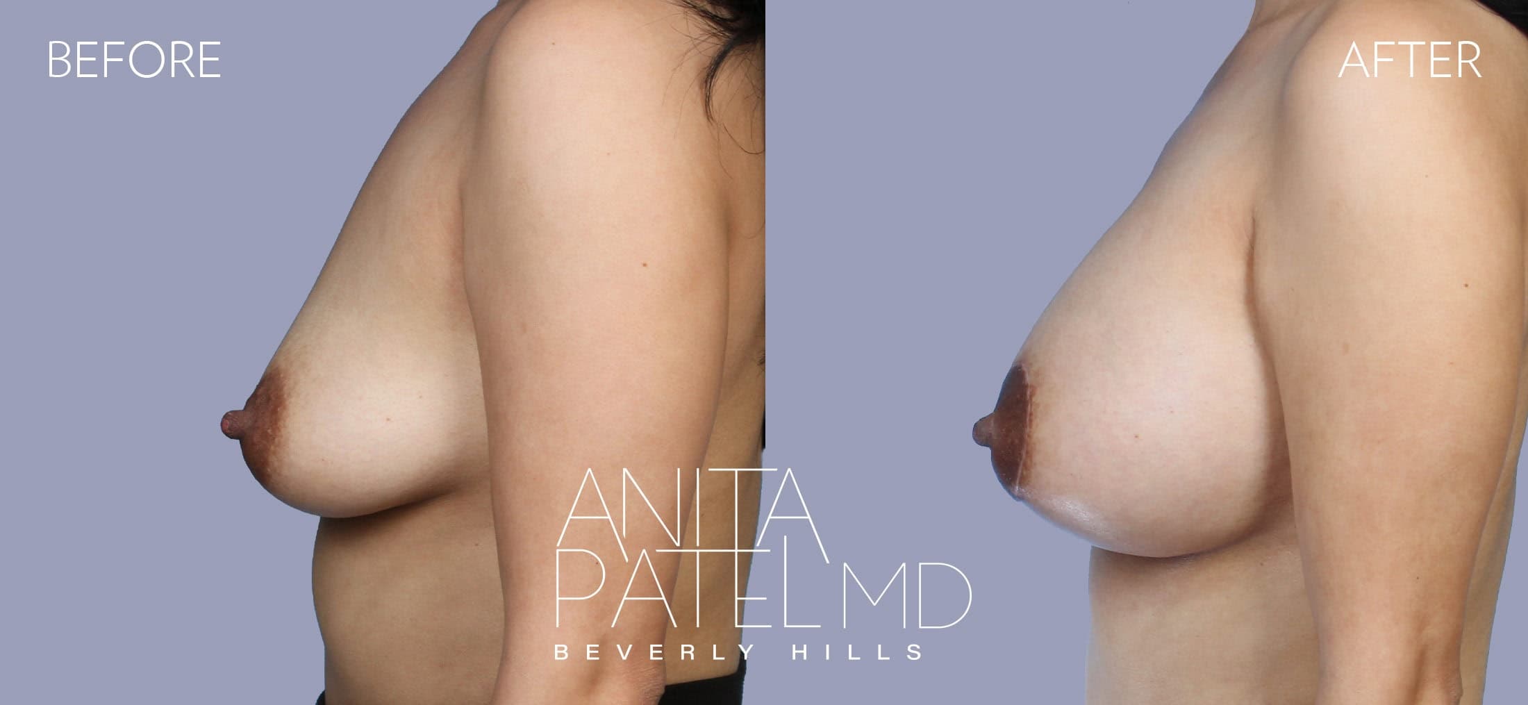 Breast Augmentation with Lift before and after — Patient 3, photo 5 of 5 — Dr. Anita Patel, MD, FACS, Beverly Hills