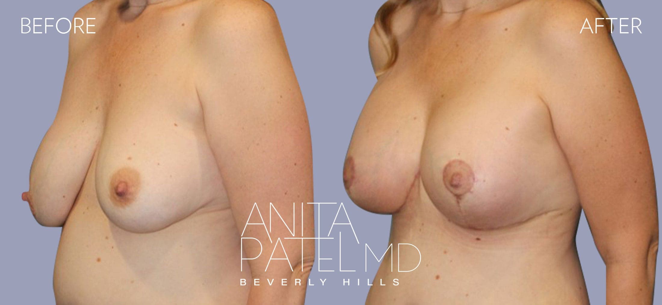 Breast Augmentation with Lift before and after — Patient 4, photo 4 of 4 — Dr. Anita Patel, MD, FACS, Beverly Hills