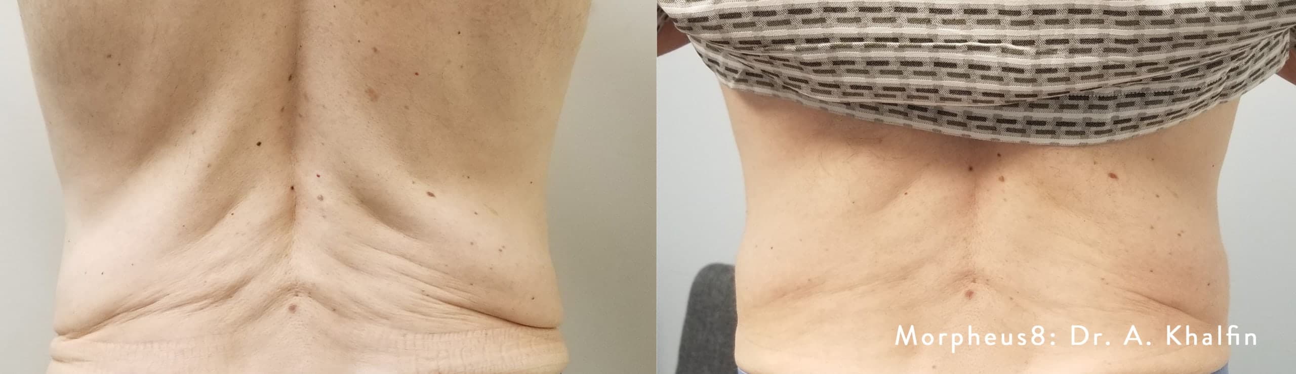 Morpheus8 RF Microneedling before and after — Patient 10 — Dr. Anita Patel, MD, FACS, Beverly Hills