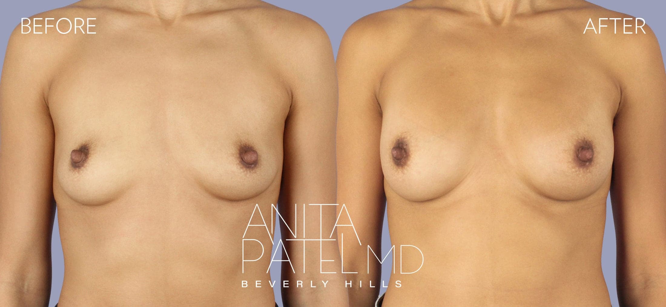 Breast Augmentation before and after — Patient 4, photo 1 of 4 — Dr. Anita Patel, MD, FACS, Beverly Hills