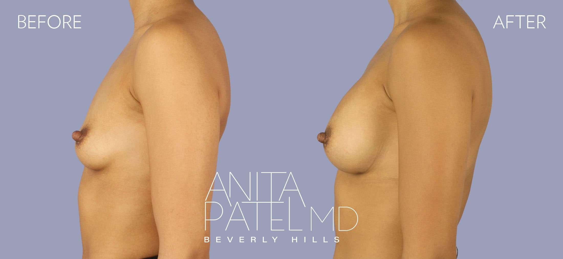Breast Augmentation before and after — Patient 4, photo 2 of 4 — Dr. Anita Patel, MD, FACS, Beverly Hills