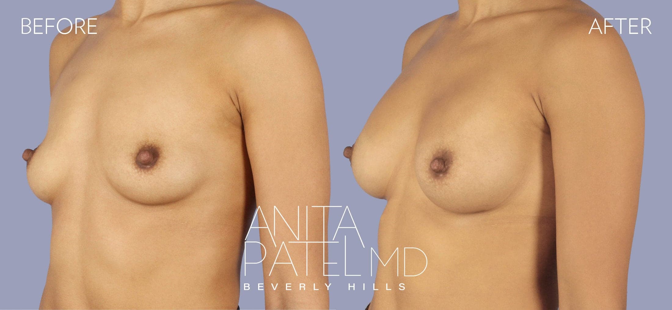 Breast Augmentation before and after — Patient 4, photo 4 of 4 — Dr. Anita Patel, MD, FACS, Beverly Hills