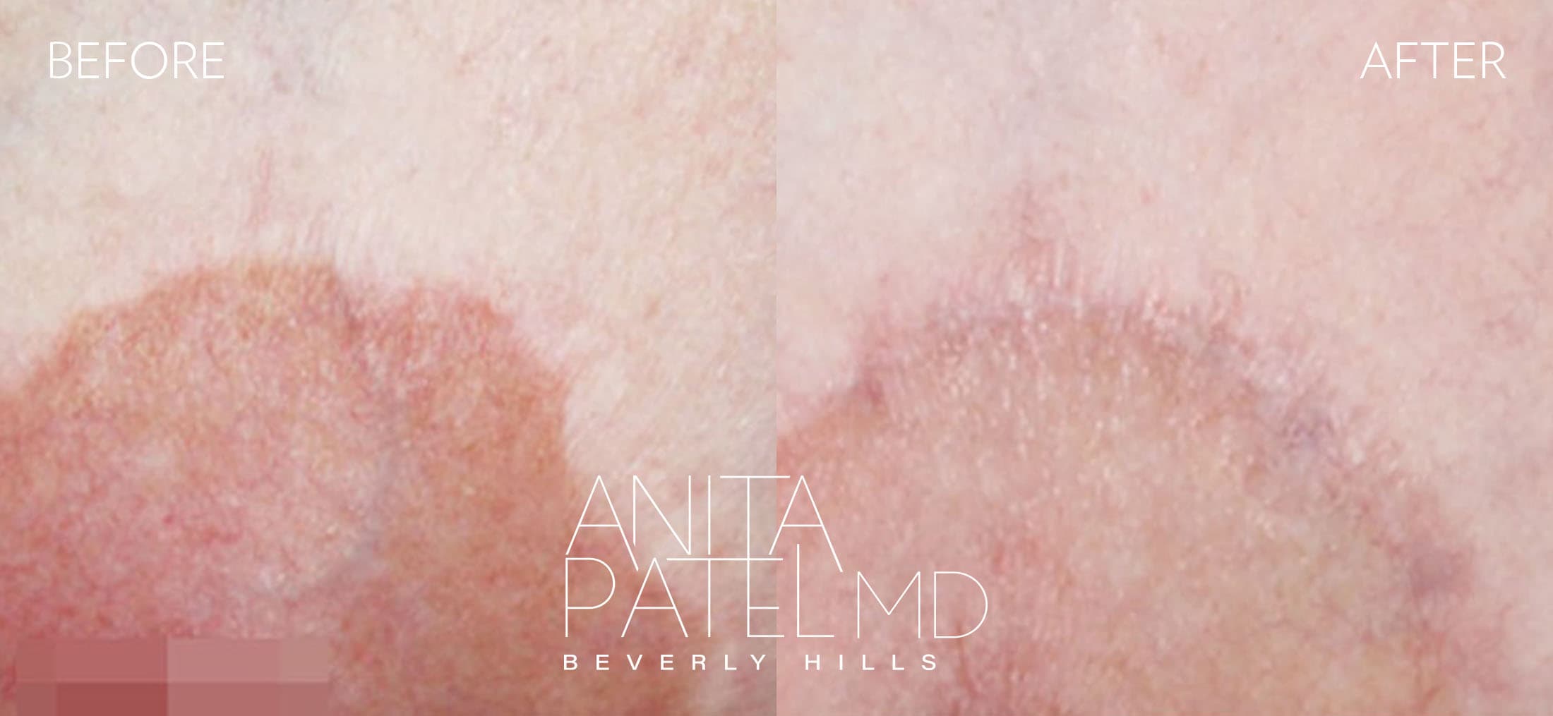 Scar Revision Removal before and after — Patient 3 — Dr. Anita Patel, MD, FACS, Beverly Hills