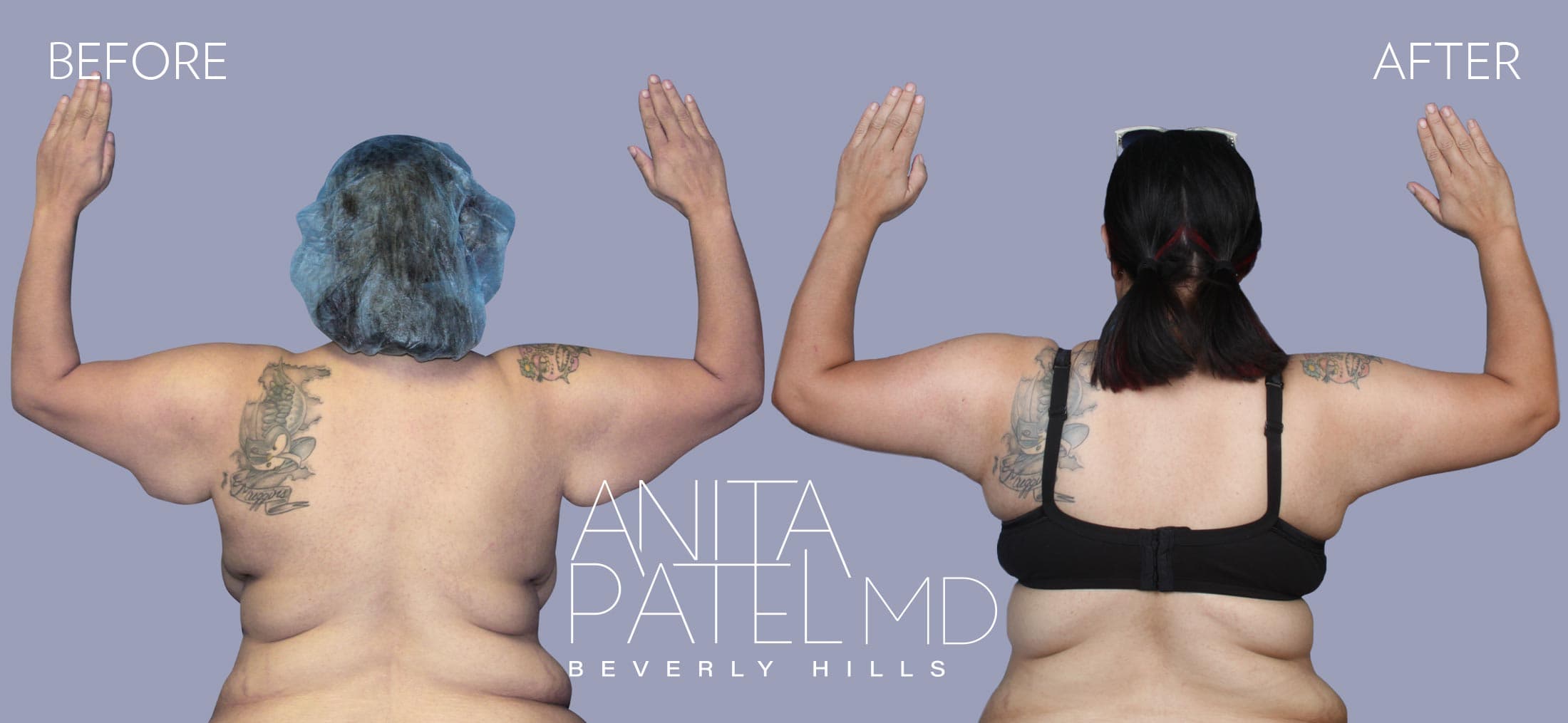 Arm Lift before and after — Dr. Anita Patel, Beverly Hills