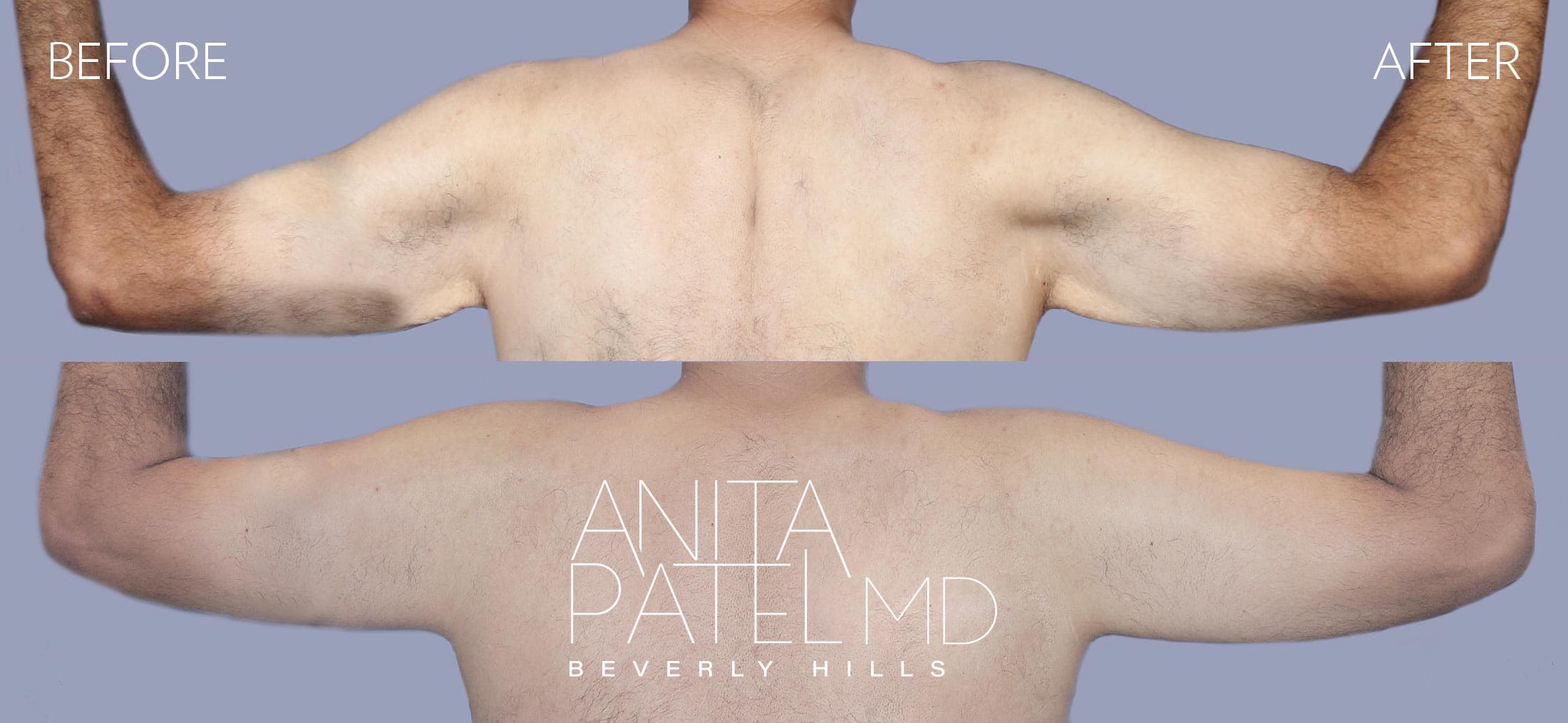 Arm Lift before and after — Patient 2, photo 1 of 2 — Dr. Anita Patel, MD, FACS, Beverly Hills