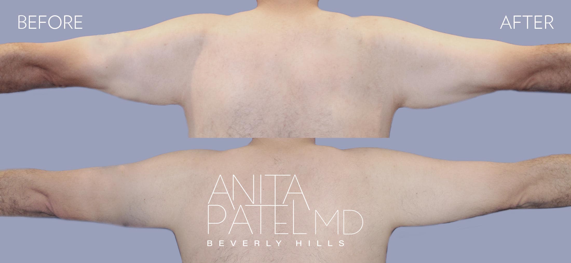 Arm Lift before and after — Patient 2, photo 2 of 2 — Dr. Anita Patel, MD, FACS, Beverly Hills