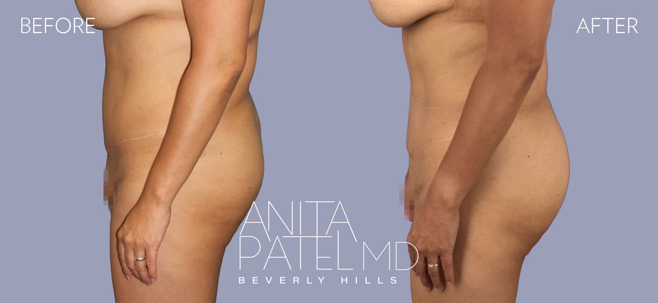 Brazilian Butt Lift before and after — Patient 2, photo 1 of 2 — Dr. Anita Patel, MD, FACS, Beverly Hills