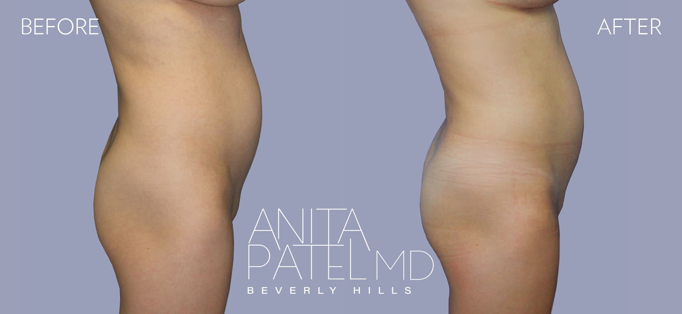 Brazilian Butt Lift before and after — Patient 3, photo 1 of 2 — Dr. Anita Patel, MD, FACS, Beverly Hills