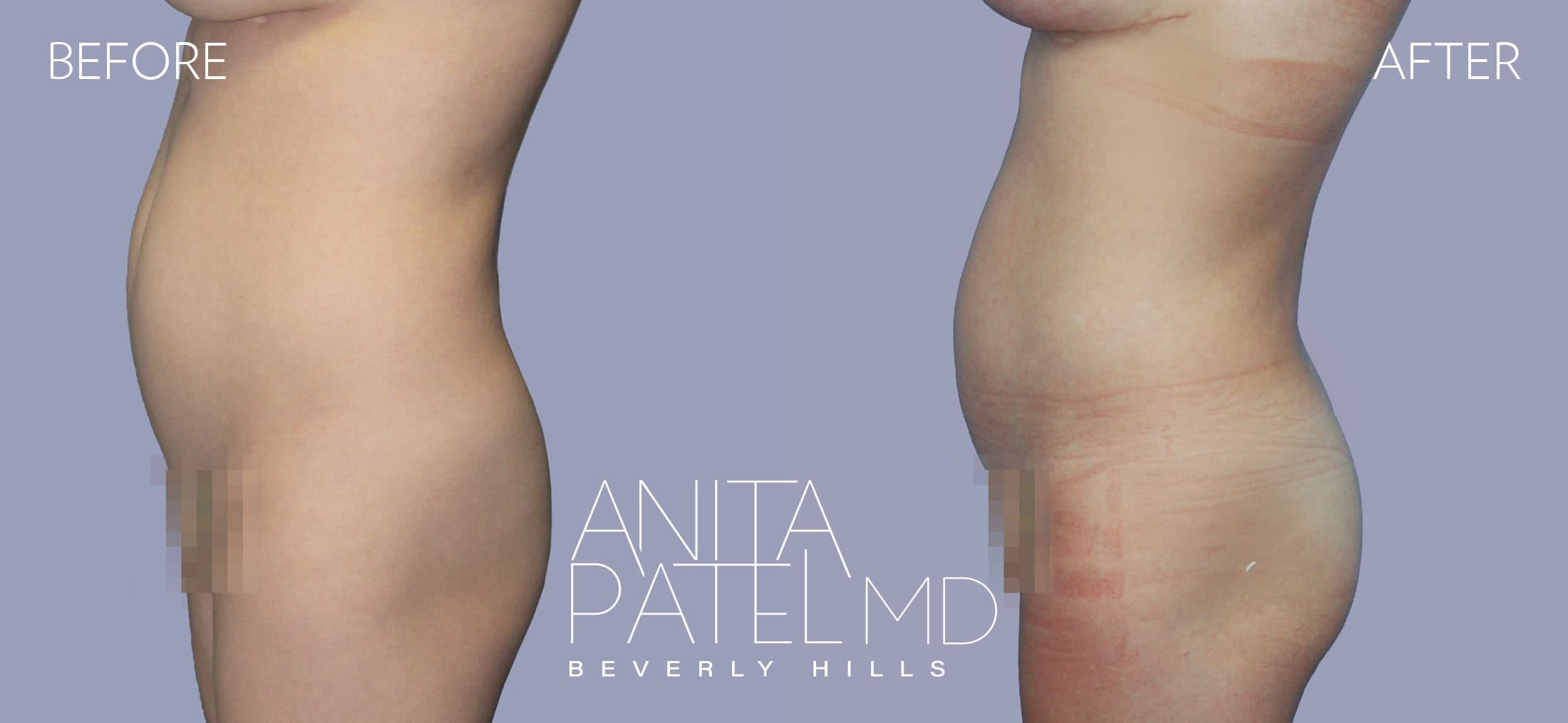 Brazilian Butt Lift before and after — Patient 3, photo 2 of 2 — Dr. Anita Patel, MD, FACS, Beverly Hills