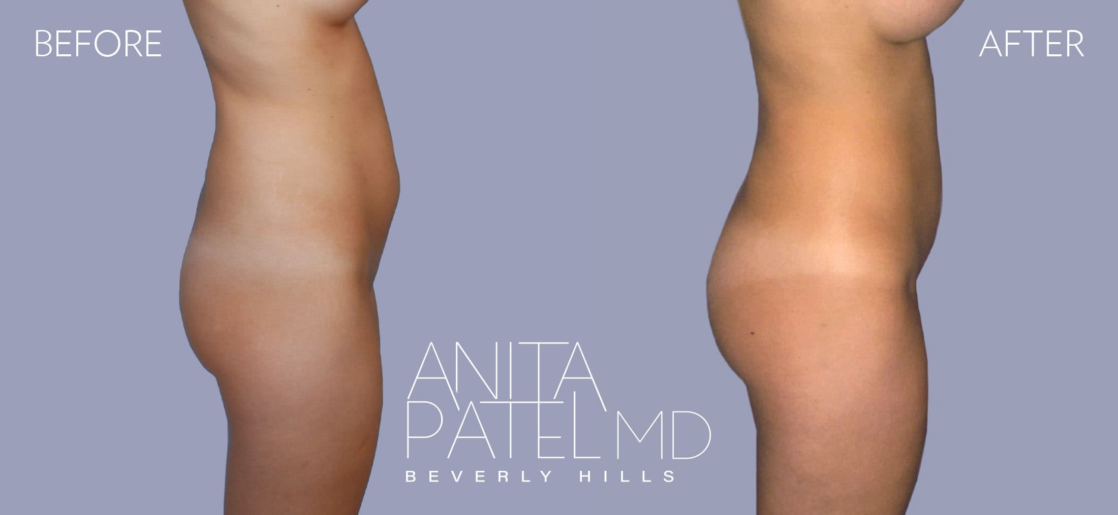 Brazilian Butt Lift before and after — Patient 1, photo 1 of 2 — Dr. Anita Patel, MD, FACS, Beverly Hills