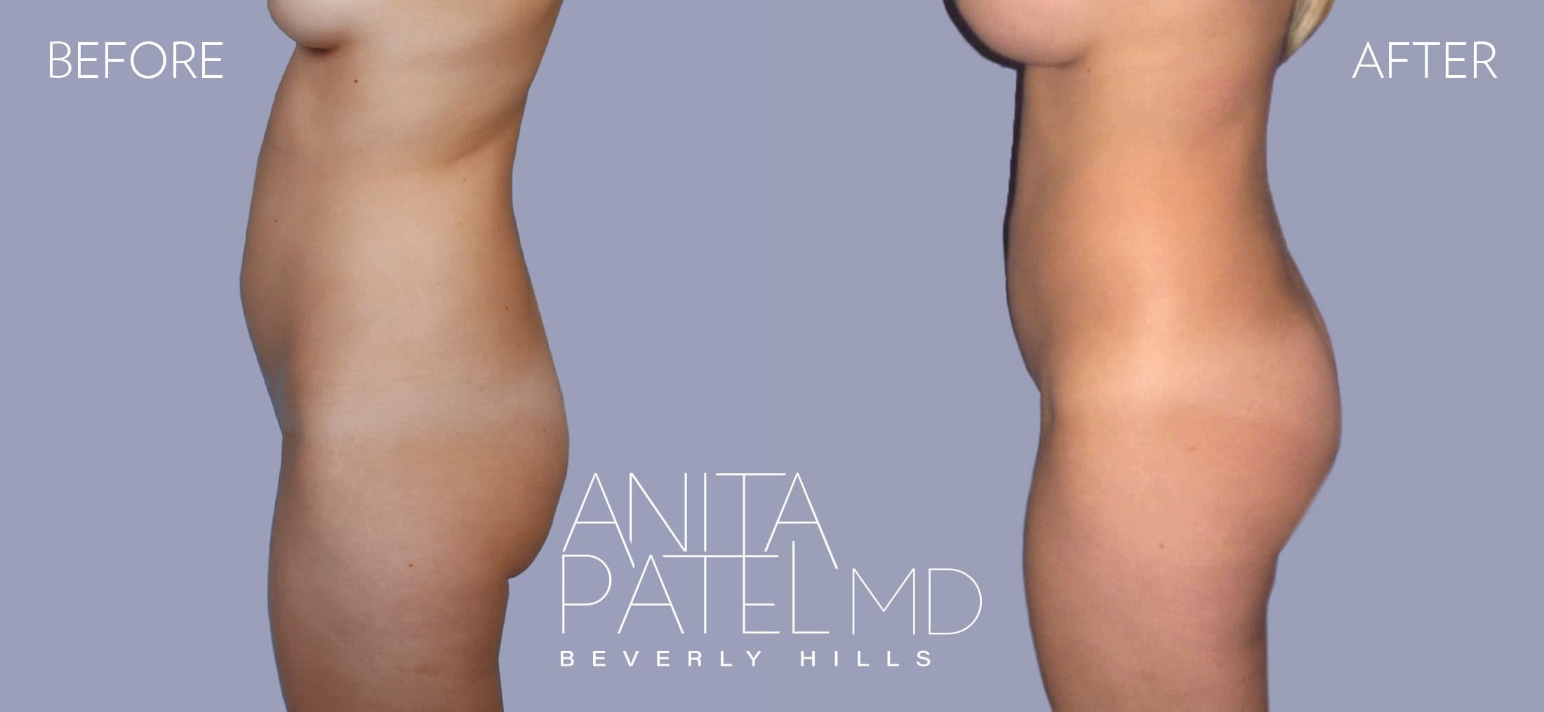 Brazilian Butt Lift before and after — Patient 1, photo 2 of 2 — Dr. Anita Patel, MD, FACS, Beverly Hills