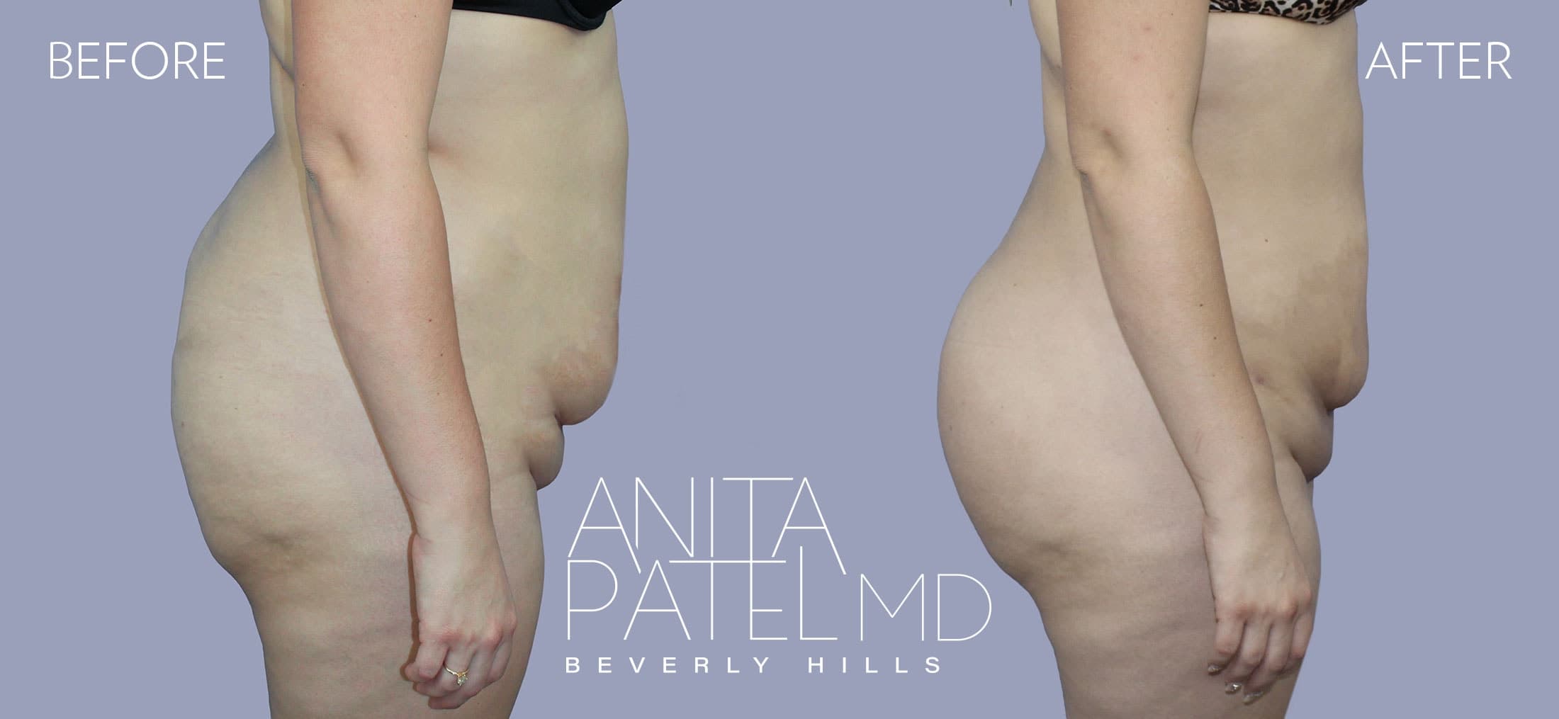 Brazilian Butt Lift before and after — Patient 4 — Dr. Anita Patel, MD, FACS, Beverly Hills