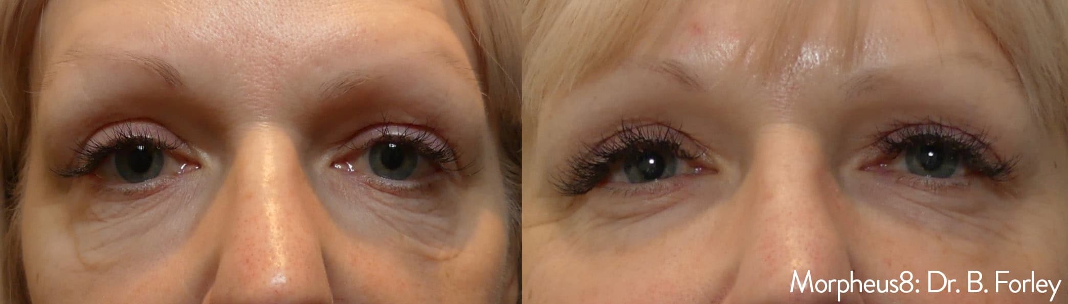 Morpheus8 RF Microneedling before and after — Patient 14 — Dr. Anita Patel, MD, FACS, Beverly Hills