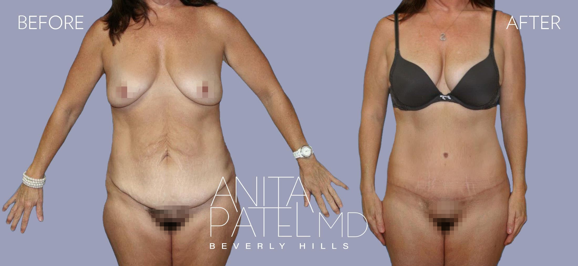 Lift Contour before and after — Patient 1, photo 1 of 6 — Dr. Anita Patel, MD, FACS, Beverly Hills