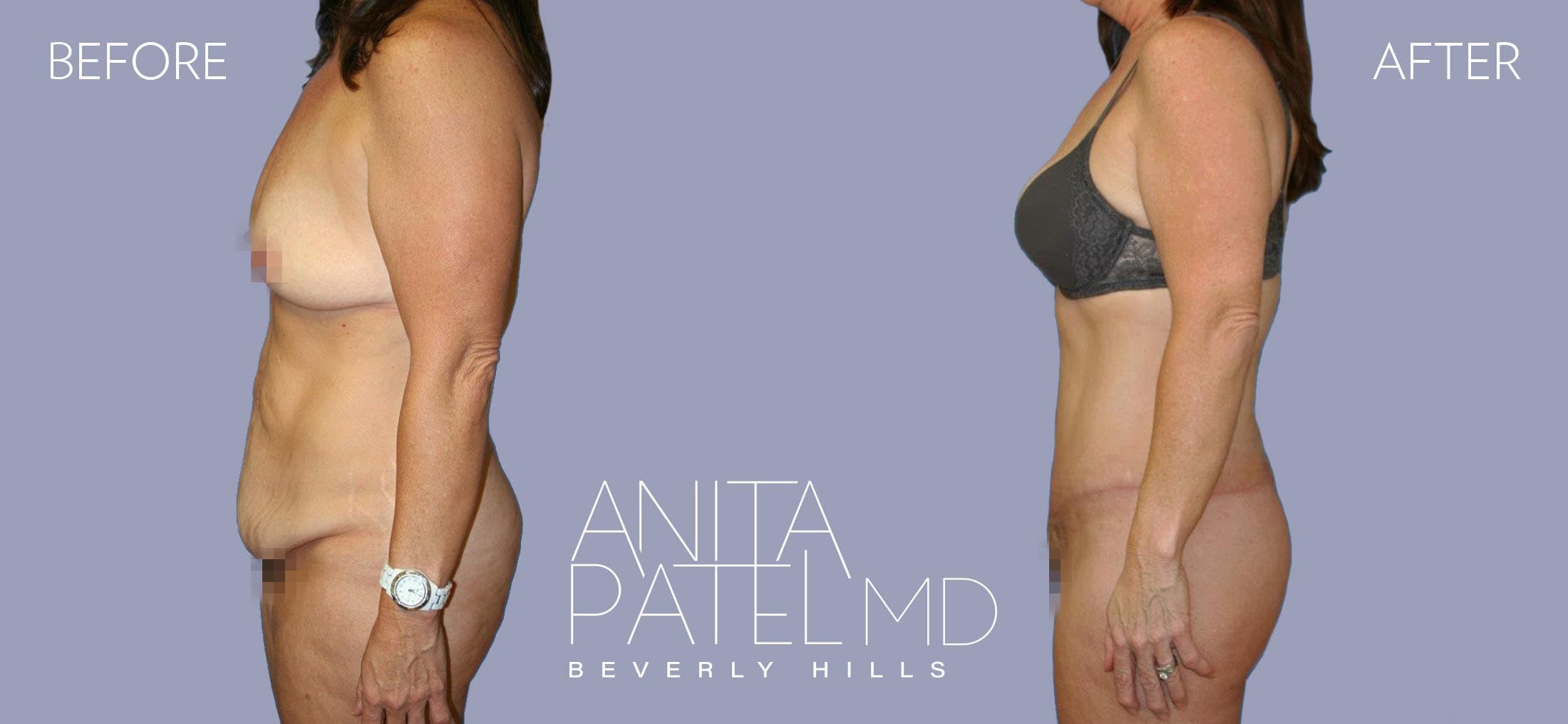 Lift Contour before and after — Patient 1, photo 5 of 6 — Dr. Anita Patel, MD, FACS, Beverly Hills