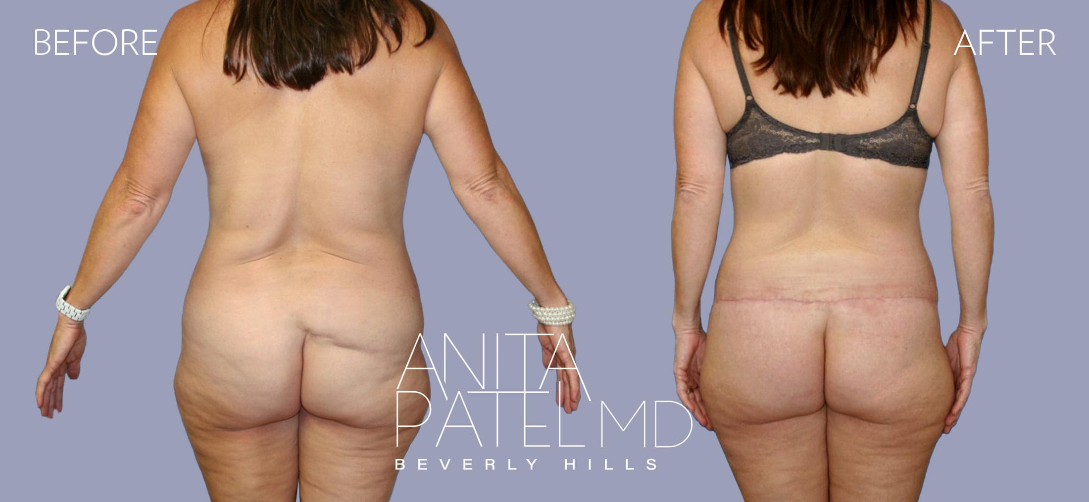 Lift Contour before and after — Patient 1, photo 6 of 6 — Dr. Anita Patel, MD, FACS, Beverly Hills