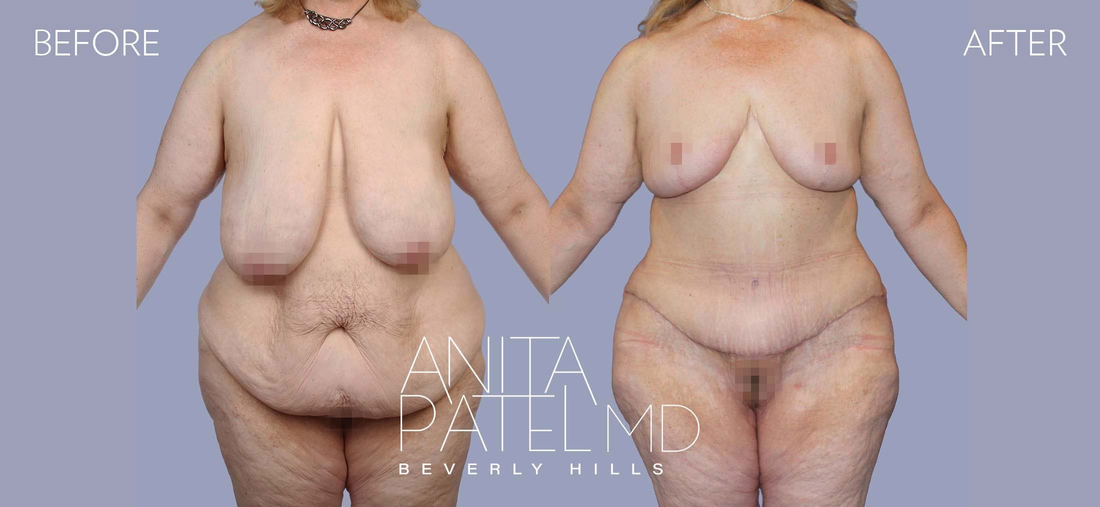 Tummy Tuck before and after — Patient 16, photo 1 of 4 — Dr. Anita Patel, MD, FACS, Beverly Hills