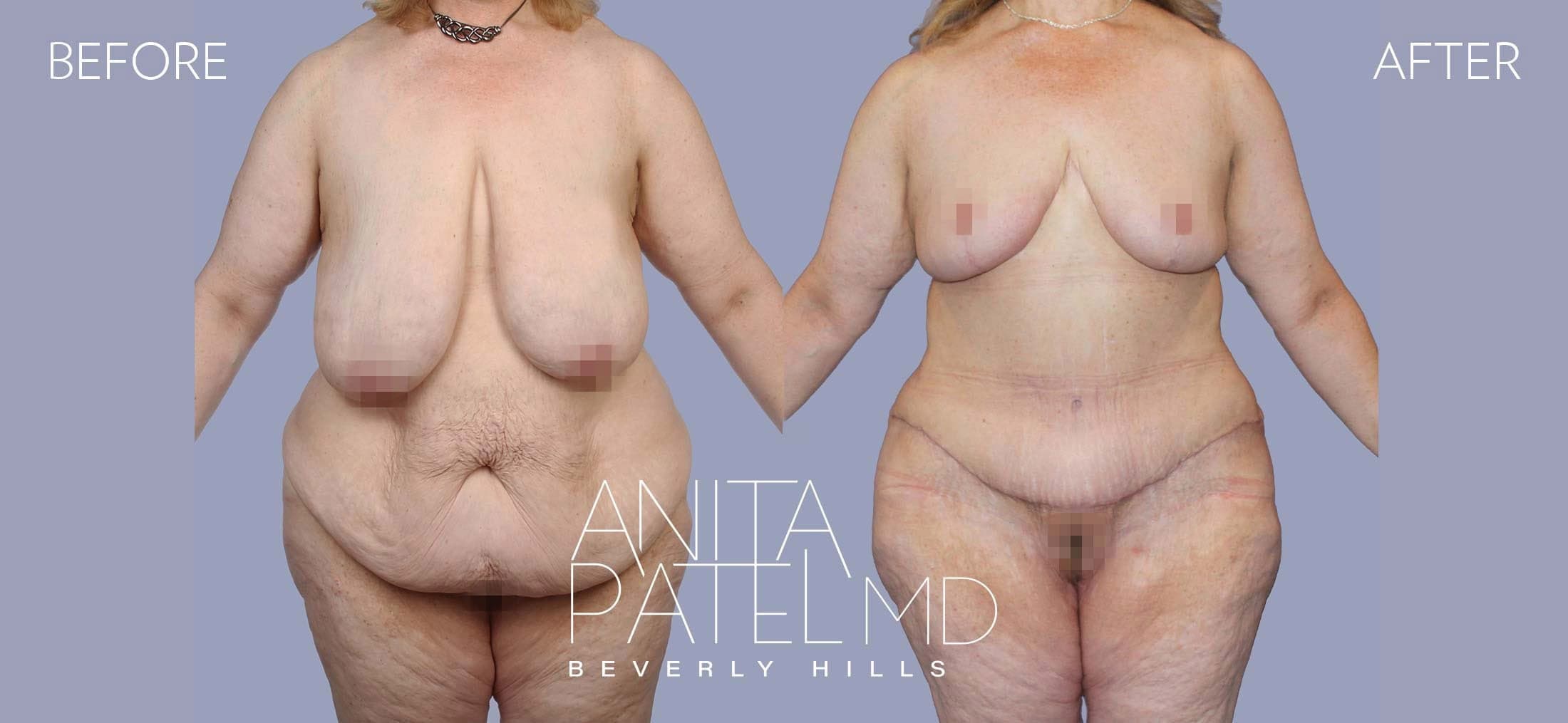 Lift Contour before and after — Patient 2, photo 1 of 5 — Dr. Anita Patel, MD, FACS, Beverly Hills