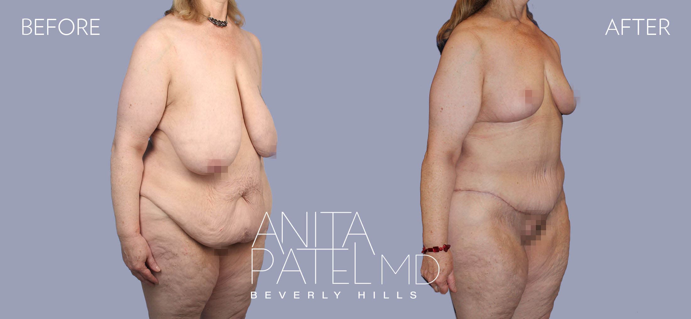 Lift Contour before and after — Patient 2, photo 2 of 5 — Dr. Anita Patel, MD, FACS, Beverly Hills