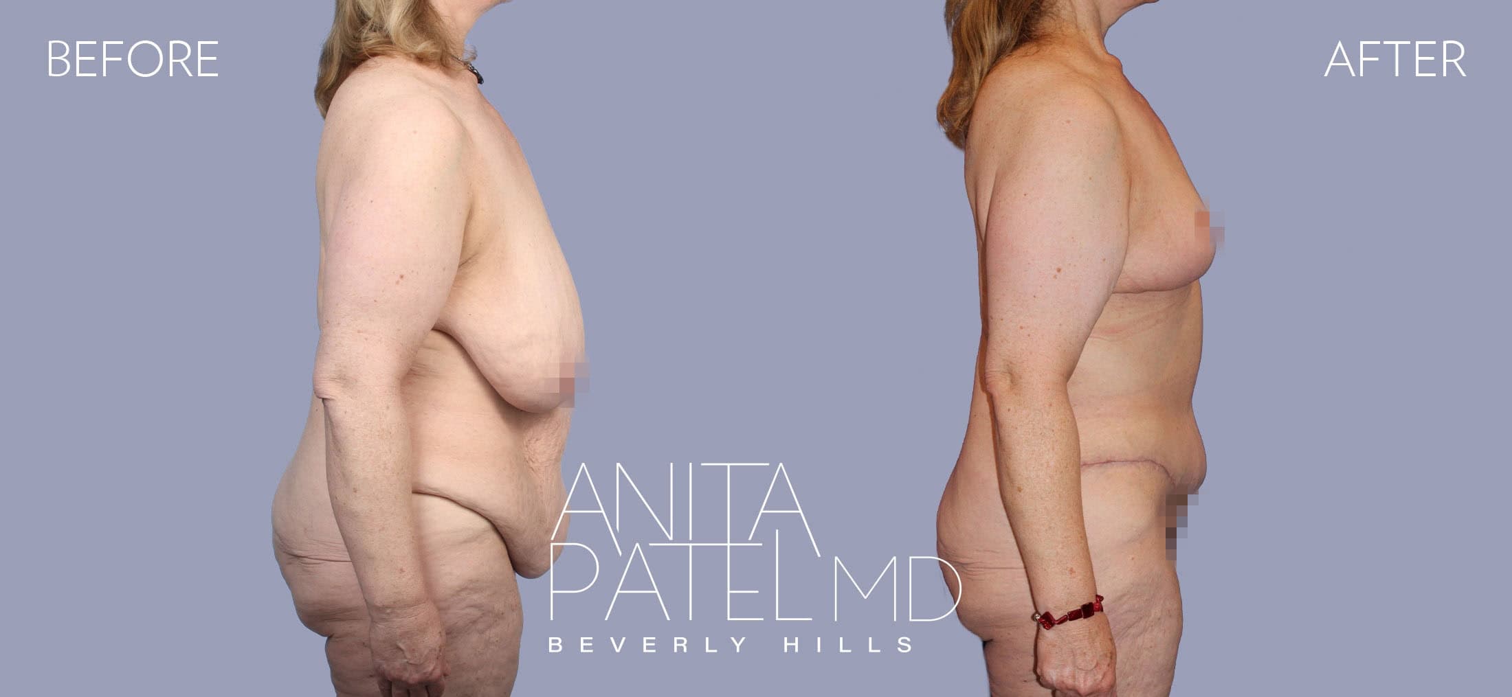 Tummy Tuck before and after — Patient 16, photo 2 of 4 — Dr. Anita Patel, MD, FACS, Beverly Hills