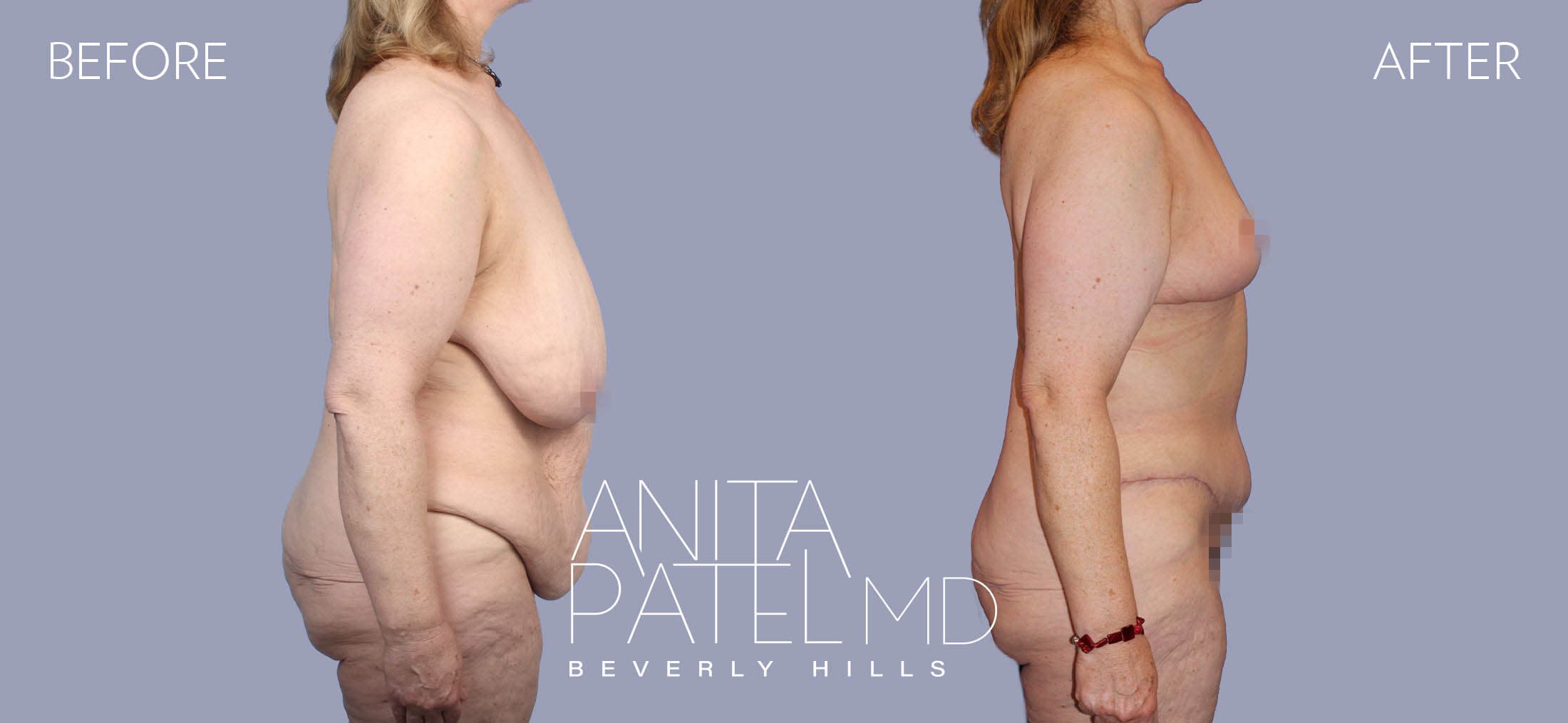 Lift Contour before and after — Patient 2, photo 3 of 5 — Dr. Anita Patel, MD, FACS, Beverly Hills